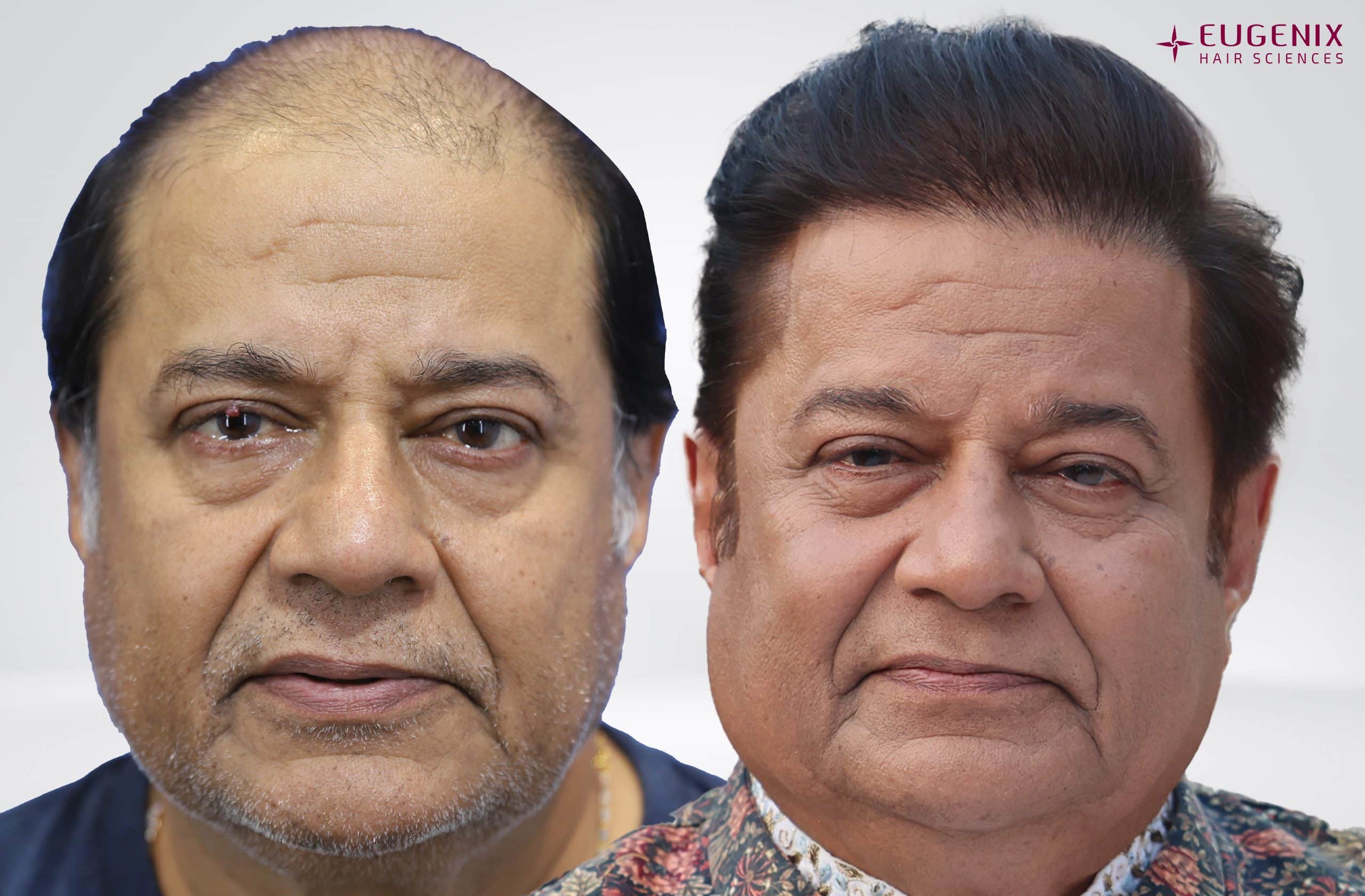 Anup Jalota Front Before and After