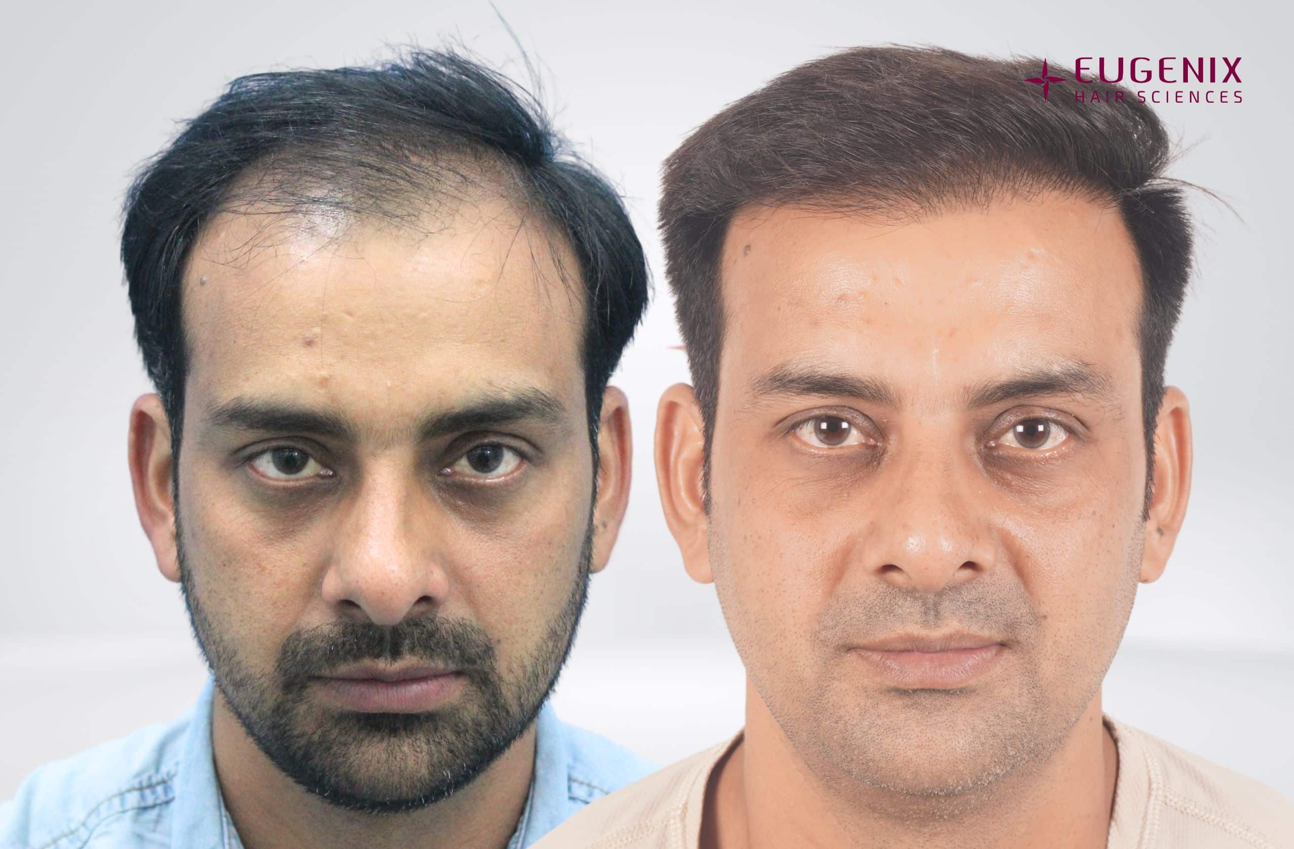 Devinder Kumar Before and After