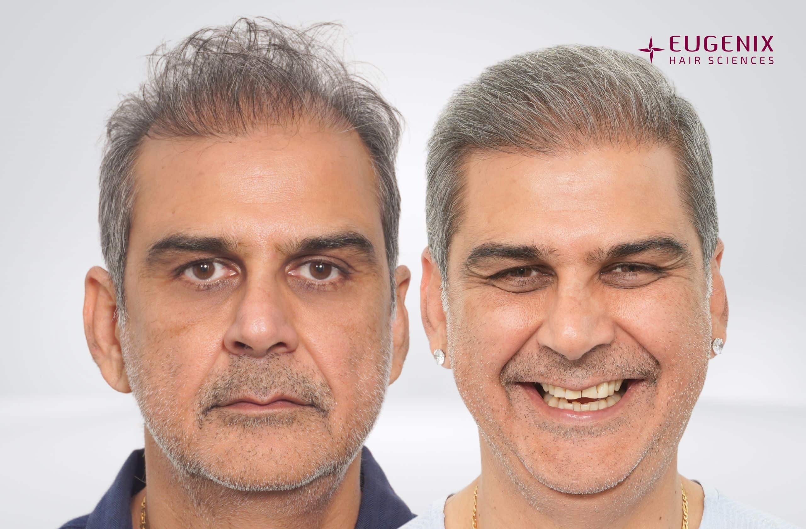 Nikhil Chopra Before and After