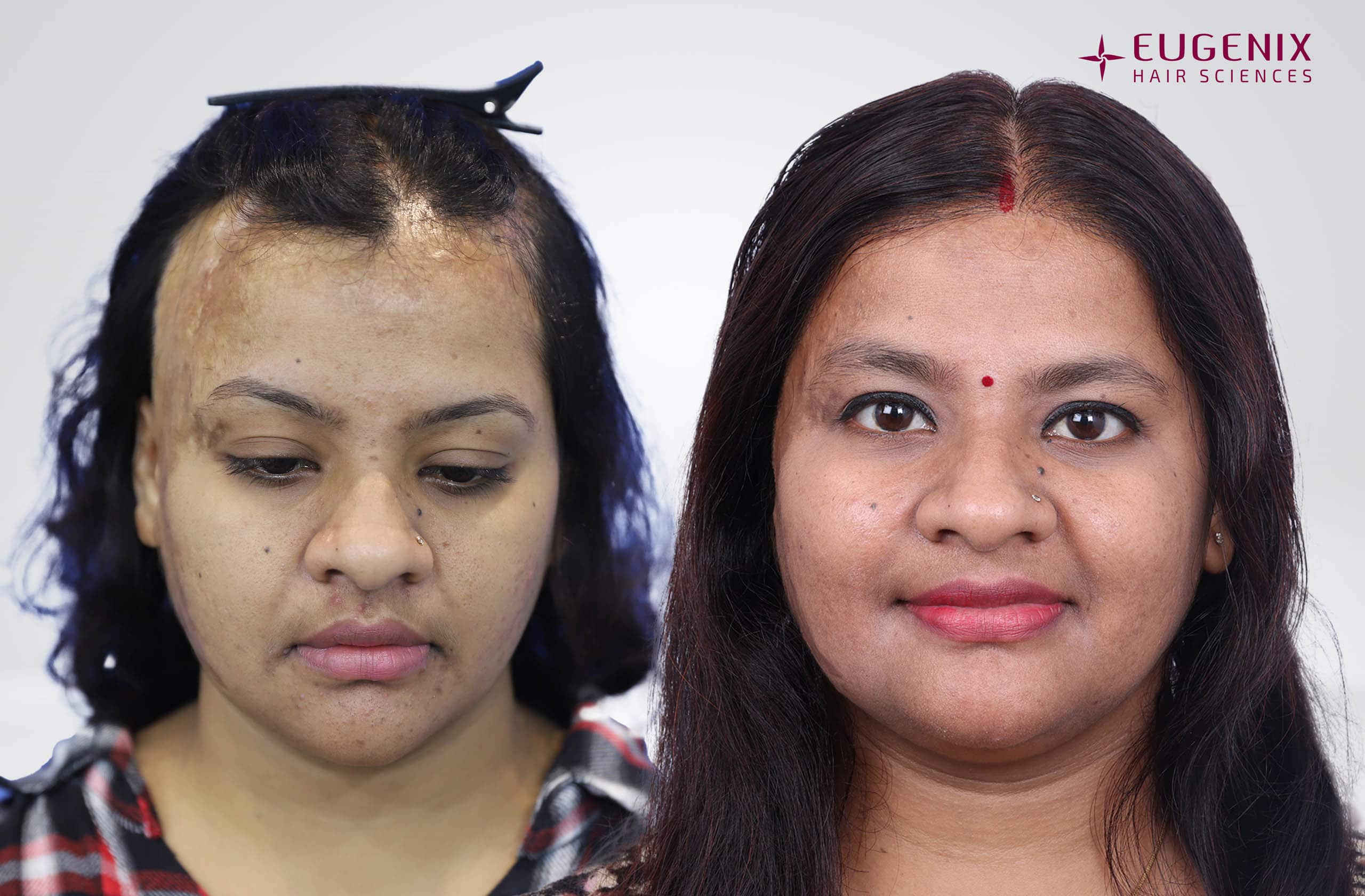 Priya Front Before After
