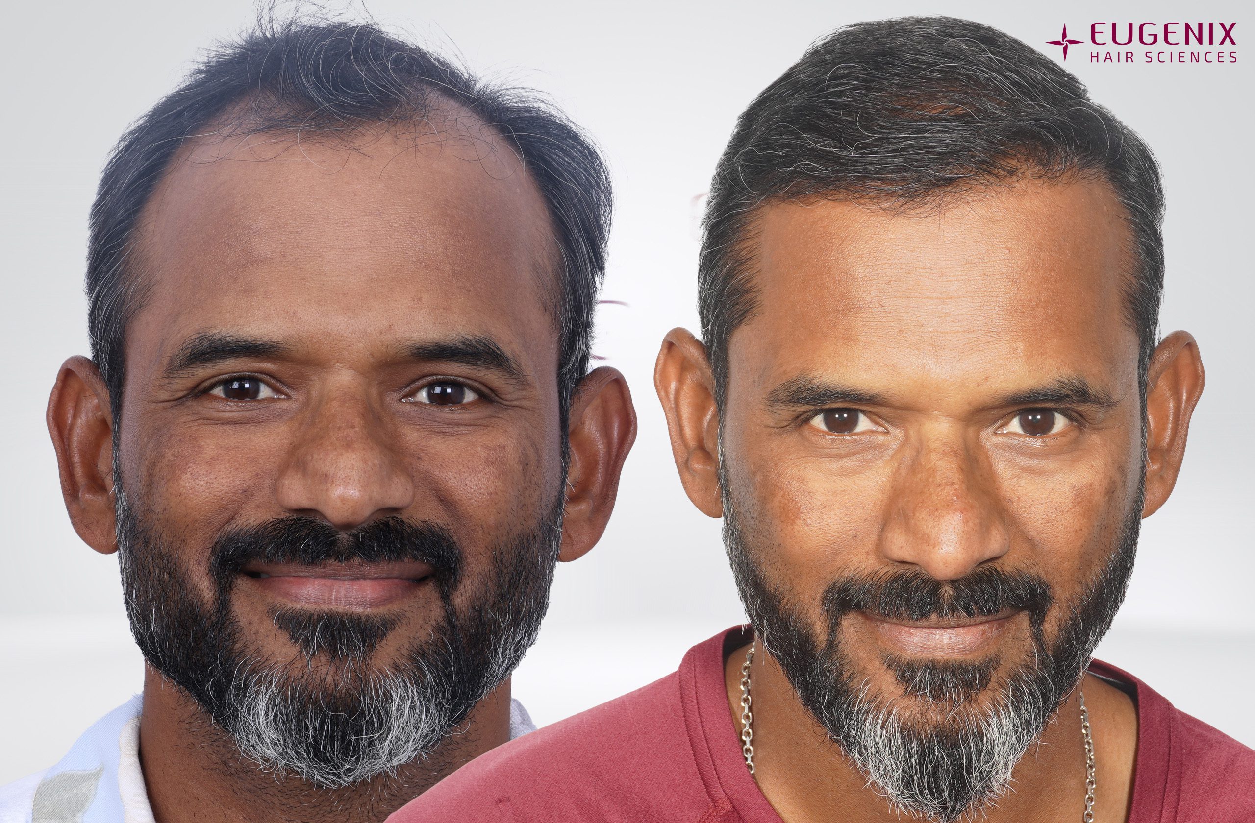 R Sridhar Head Front Before & After