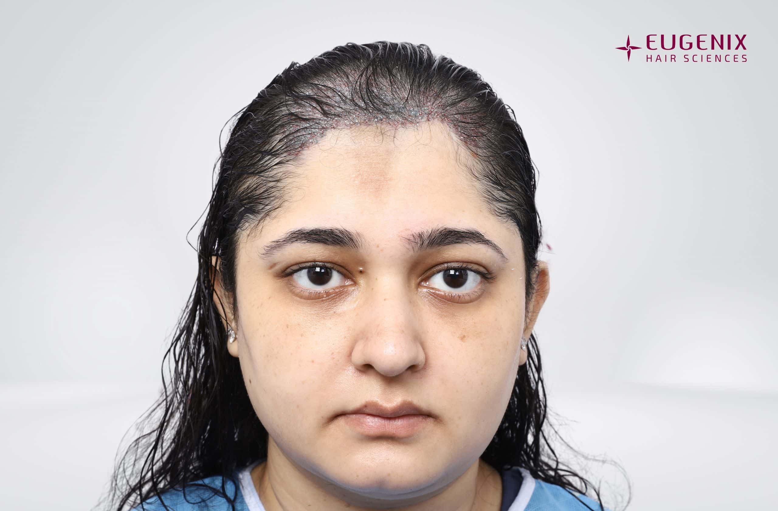 SUPARNA DHADUVAI Front - Post-op