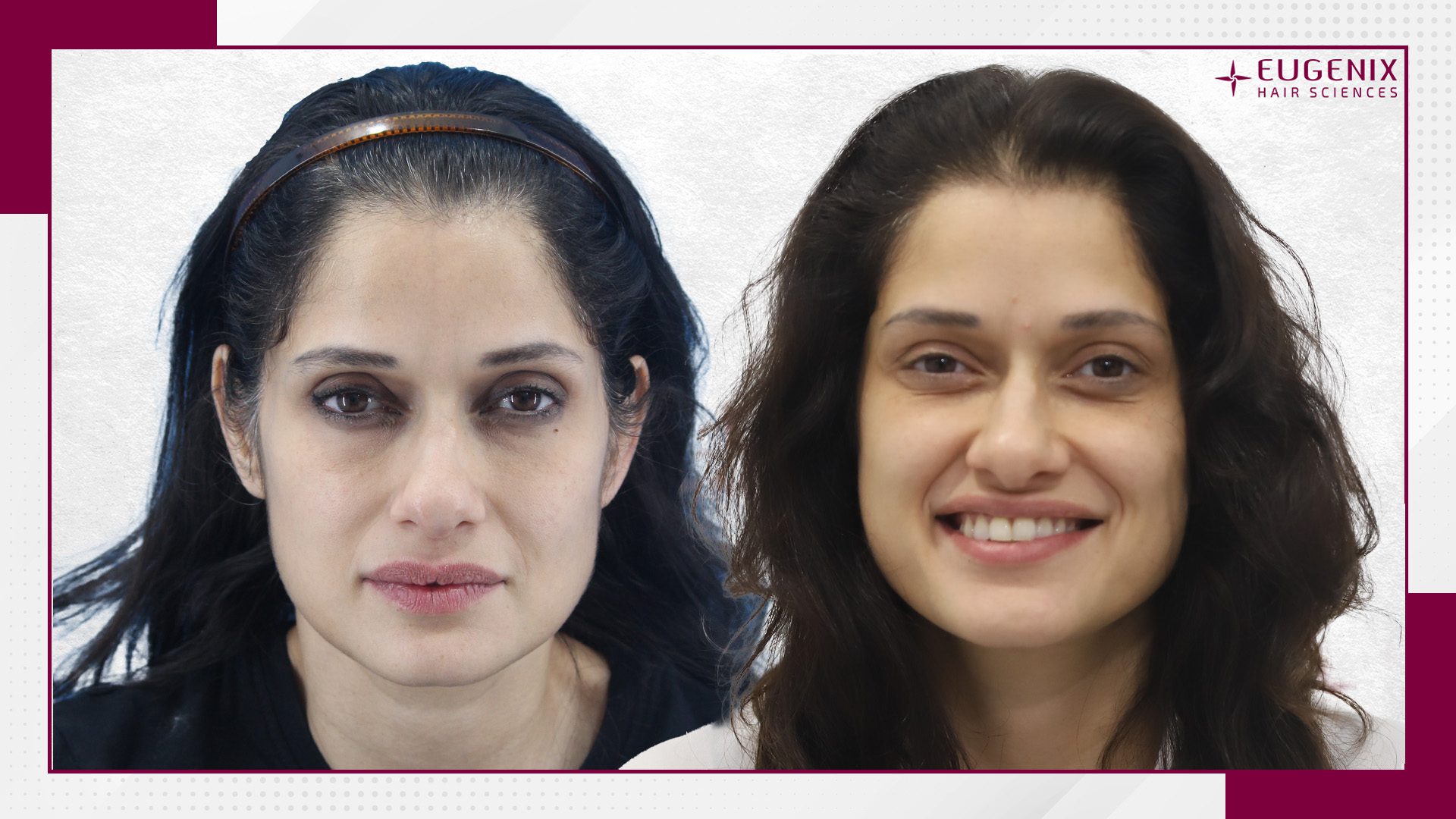 VIDUSHI MEHRA HT After and Before