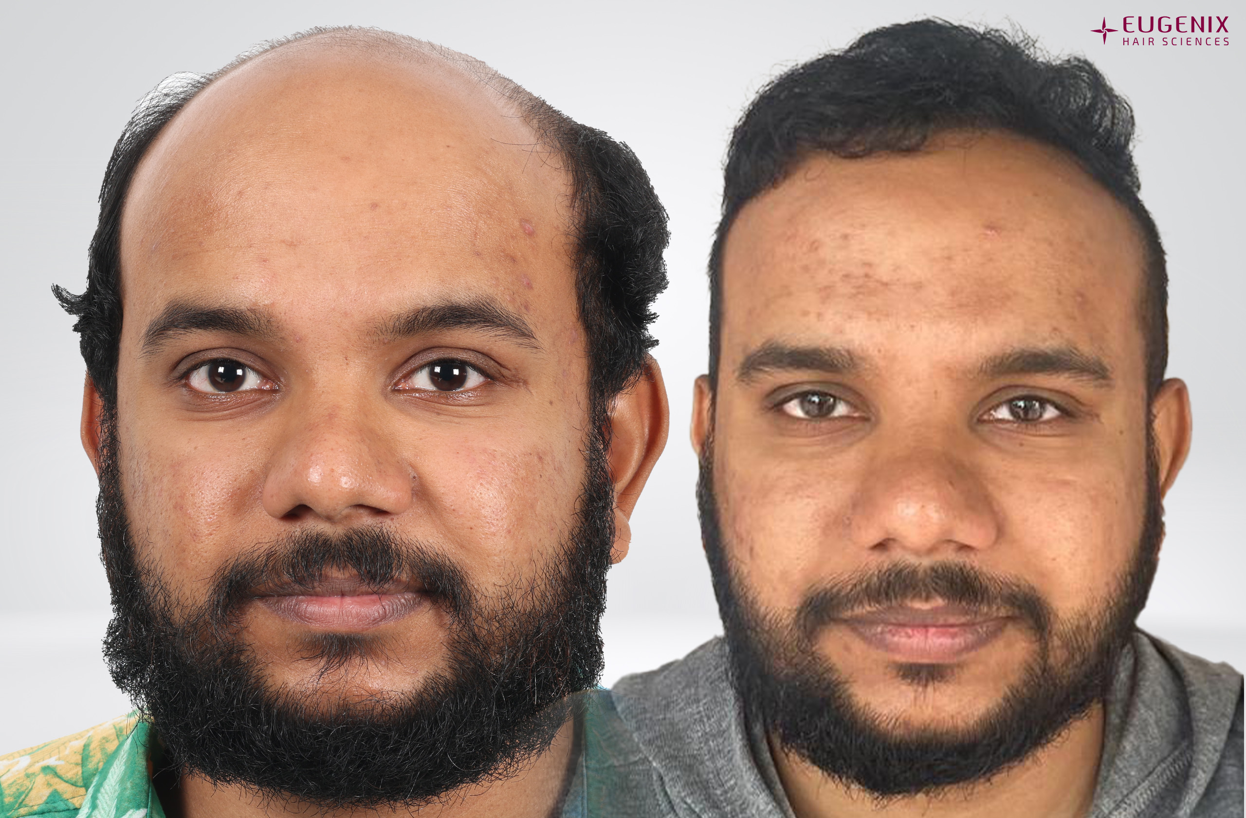 DR MOHAMED KASSIM AAZIM Front Before & After