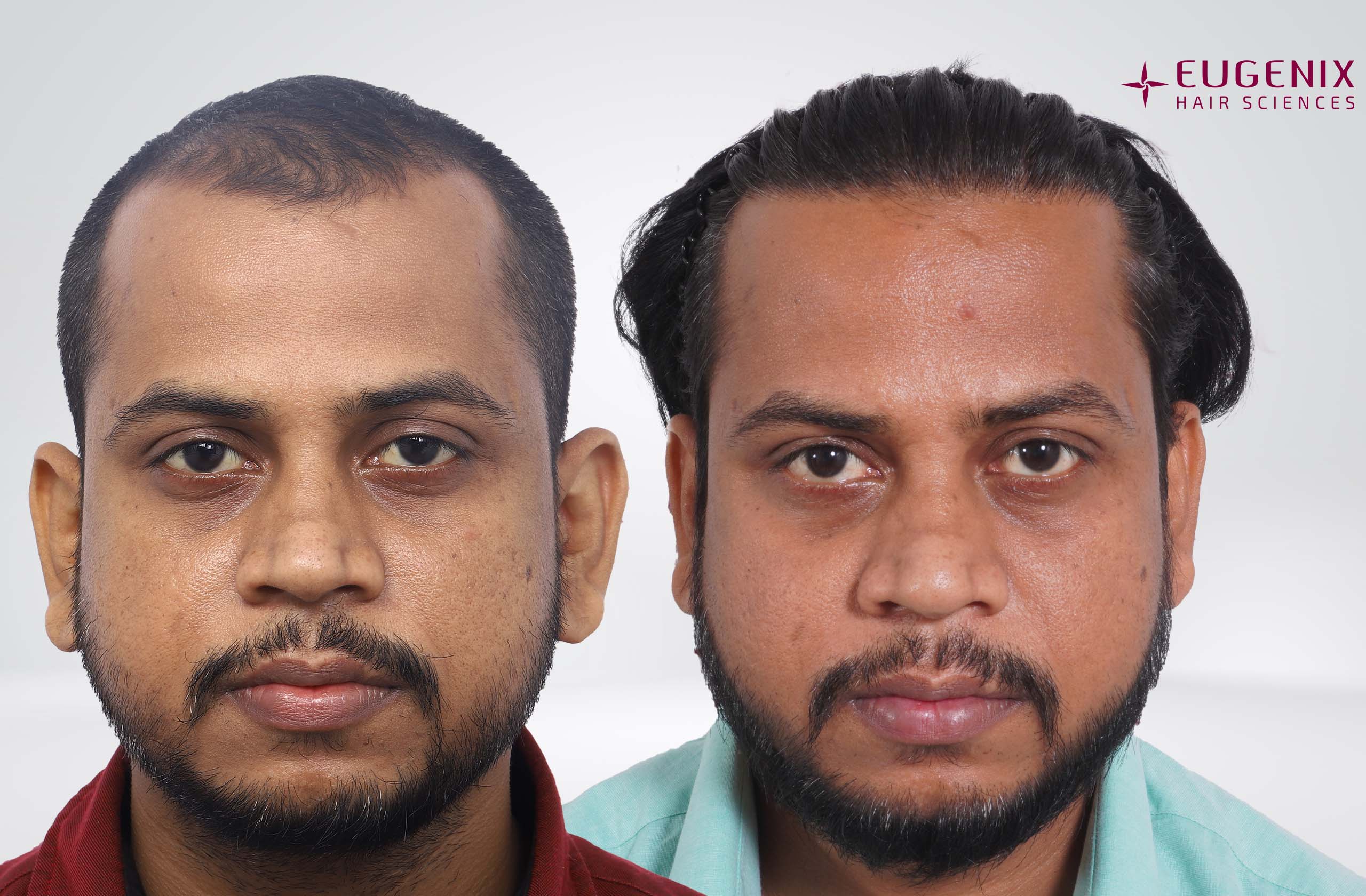 Manish Front Before After