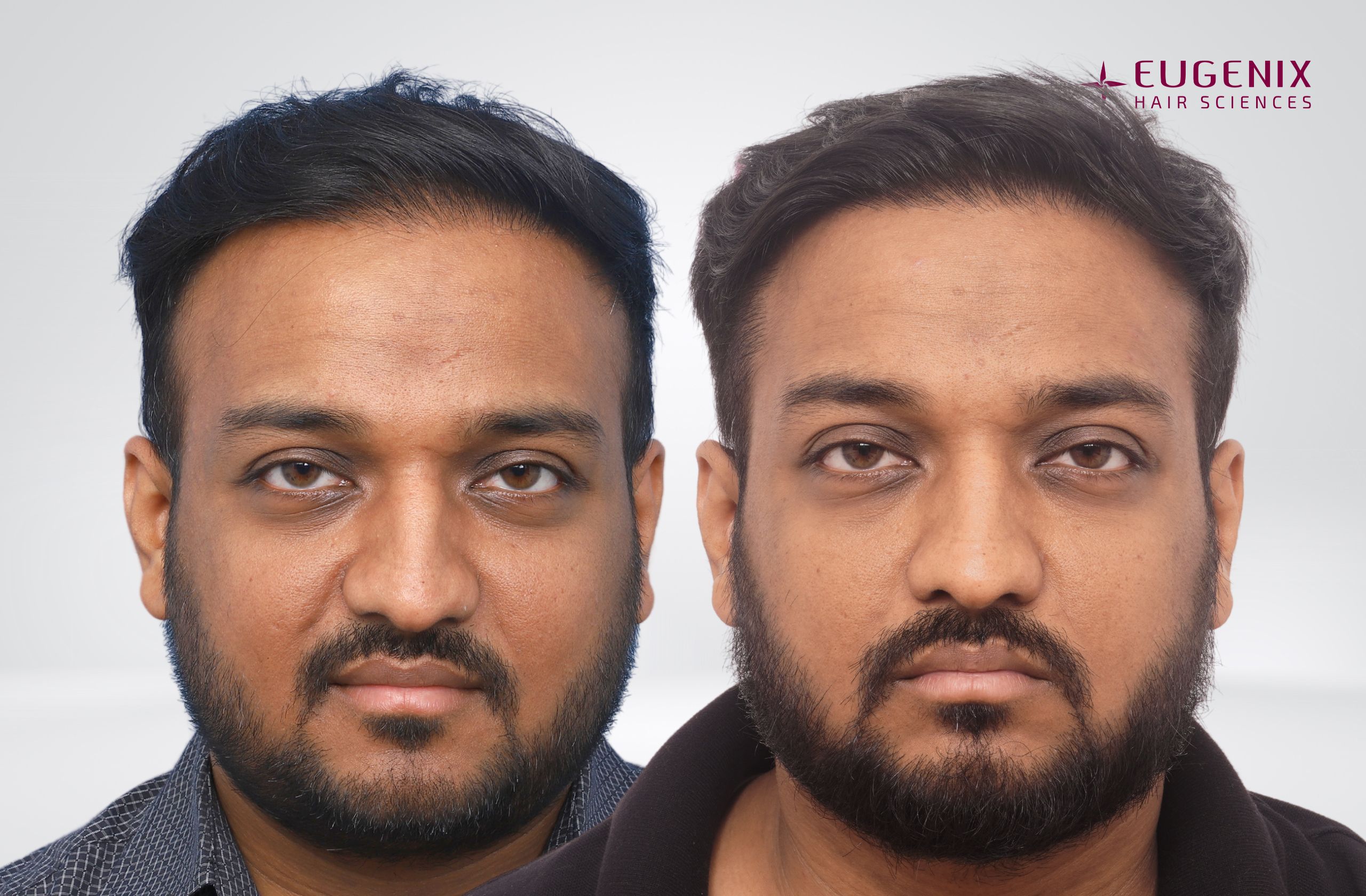 SACHIN GOYAL Before and After