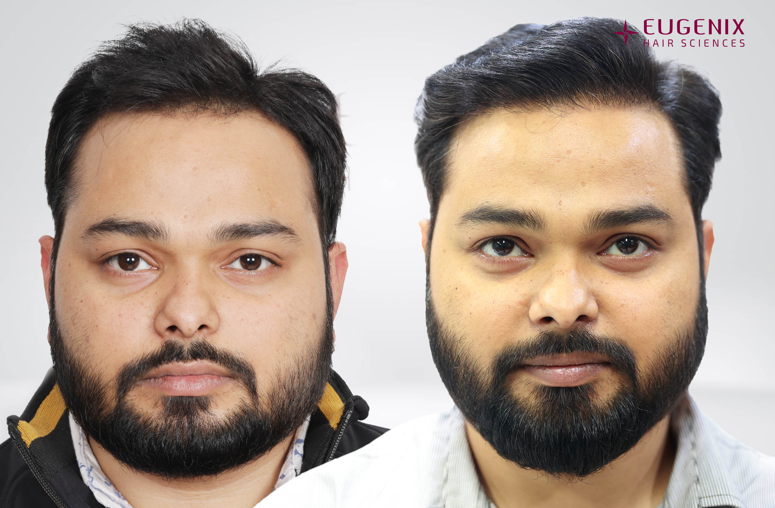 Suraj Front Before After