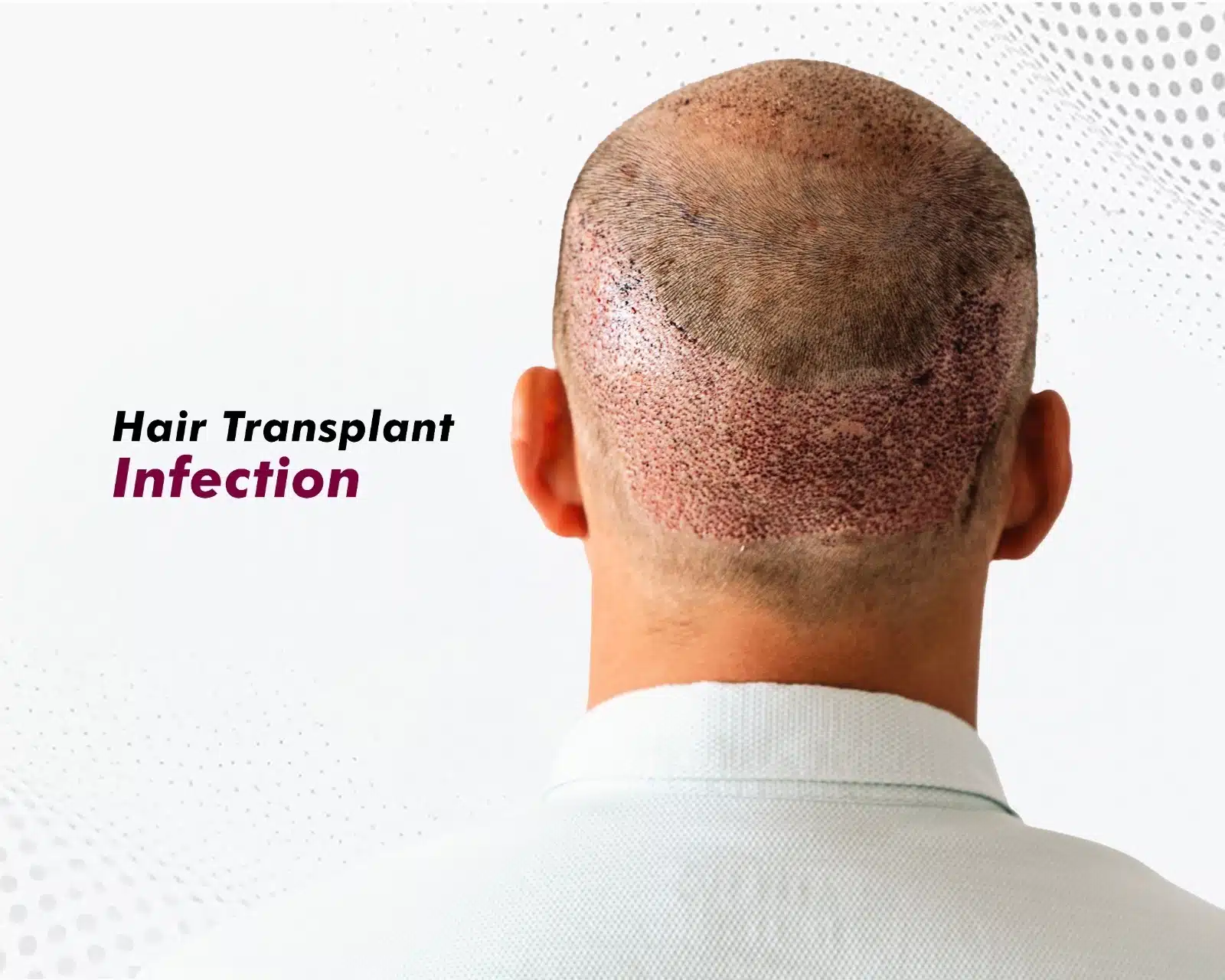 Hair Transplant Infection