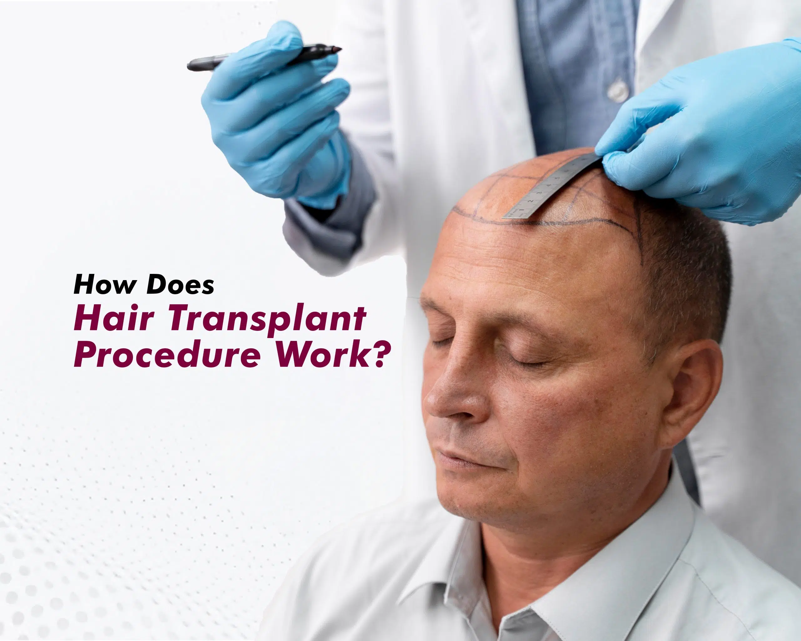 hair-transplant-procedure