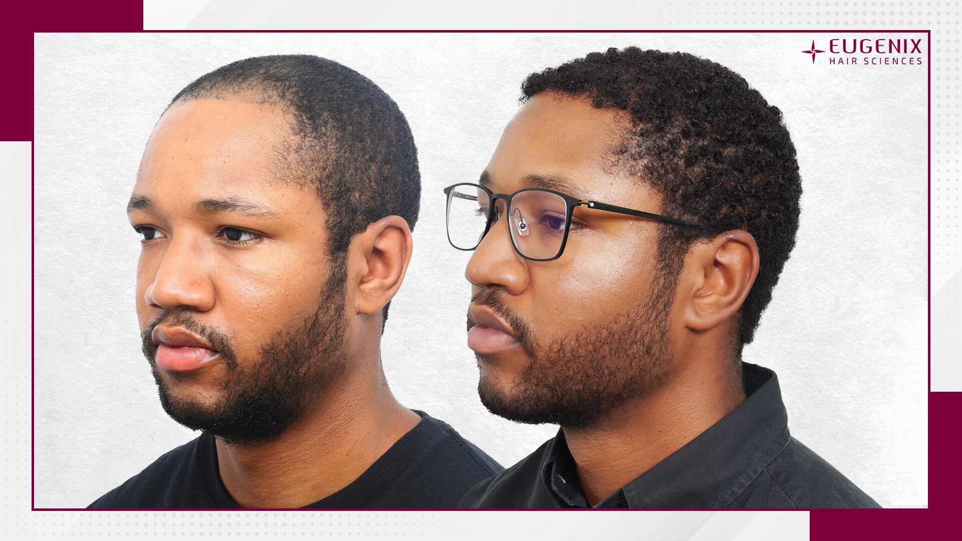 Afro Hair Transplant