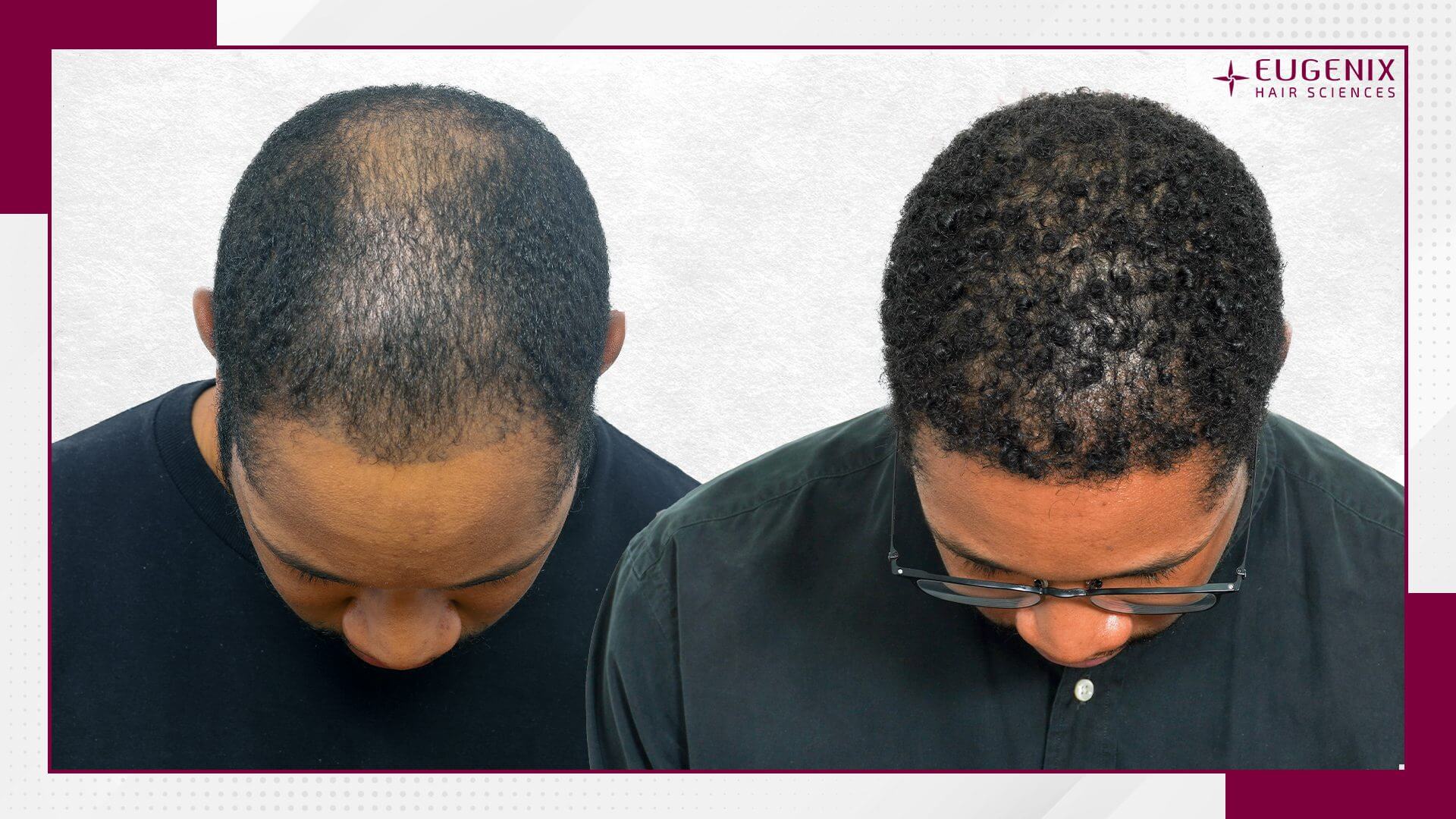 Afro Hair Transplant