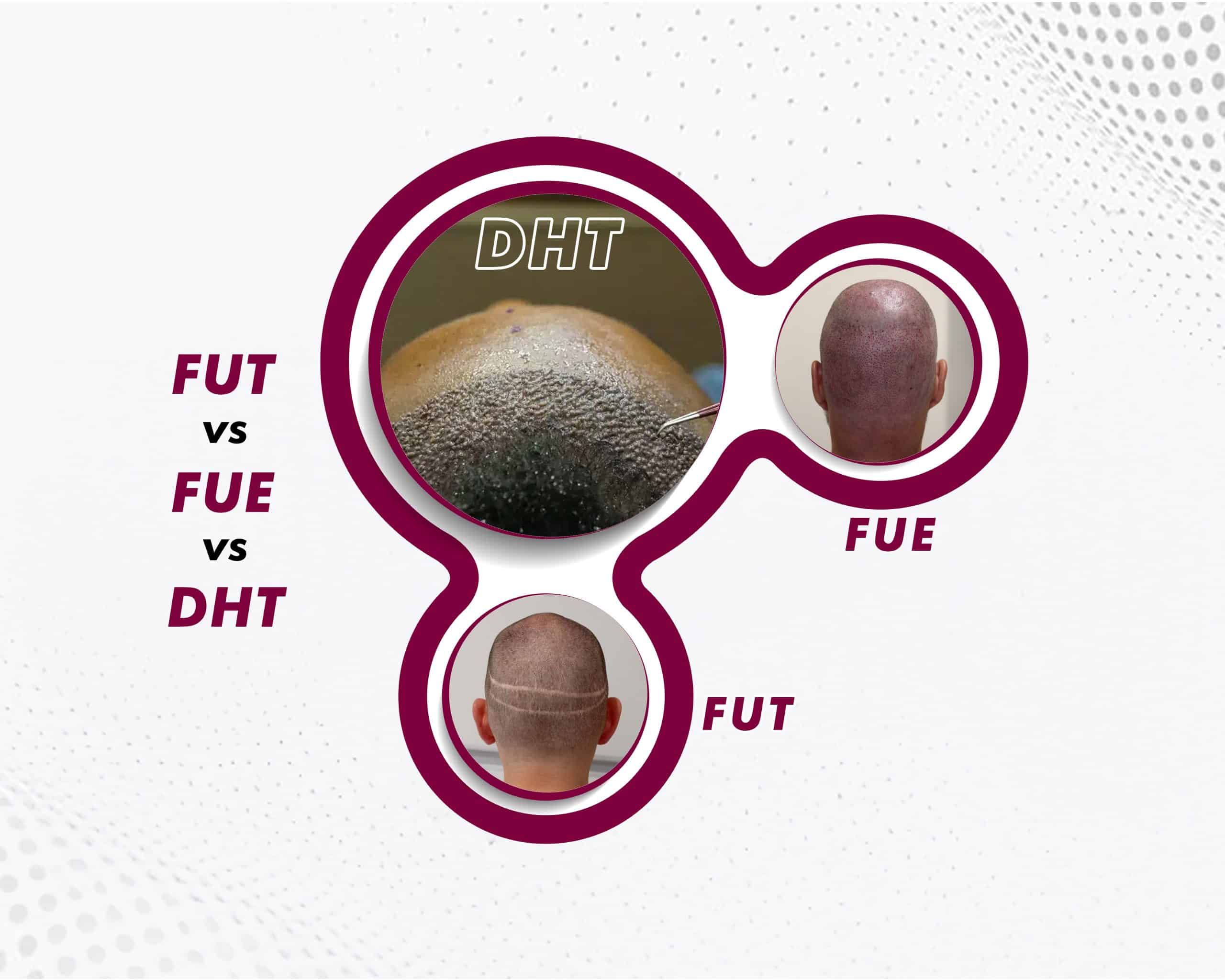 fut-vs-fue-vs-dht