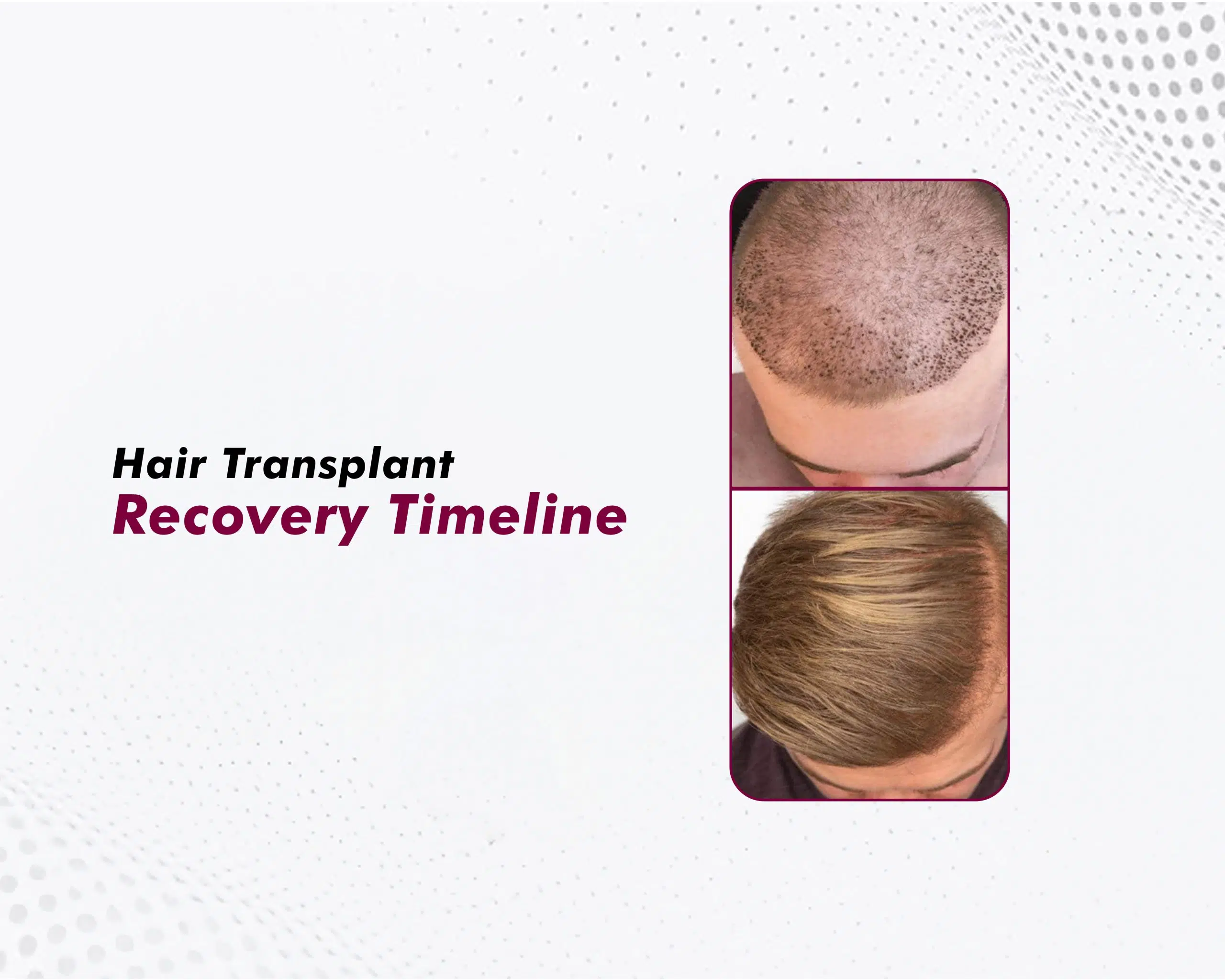 hair-transplant-recovery-timeline