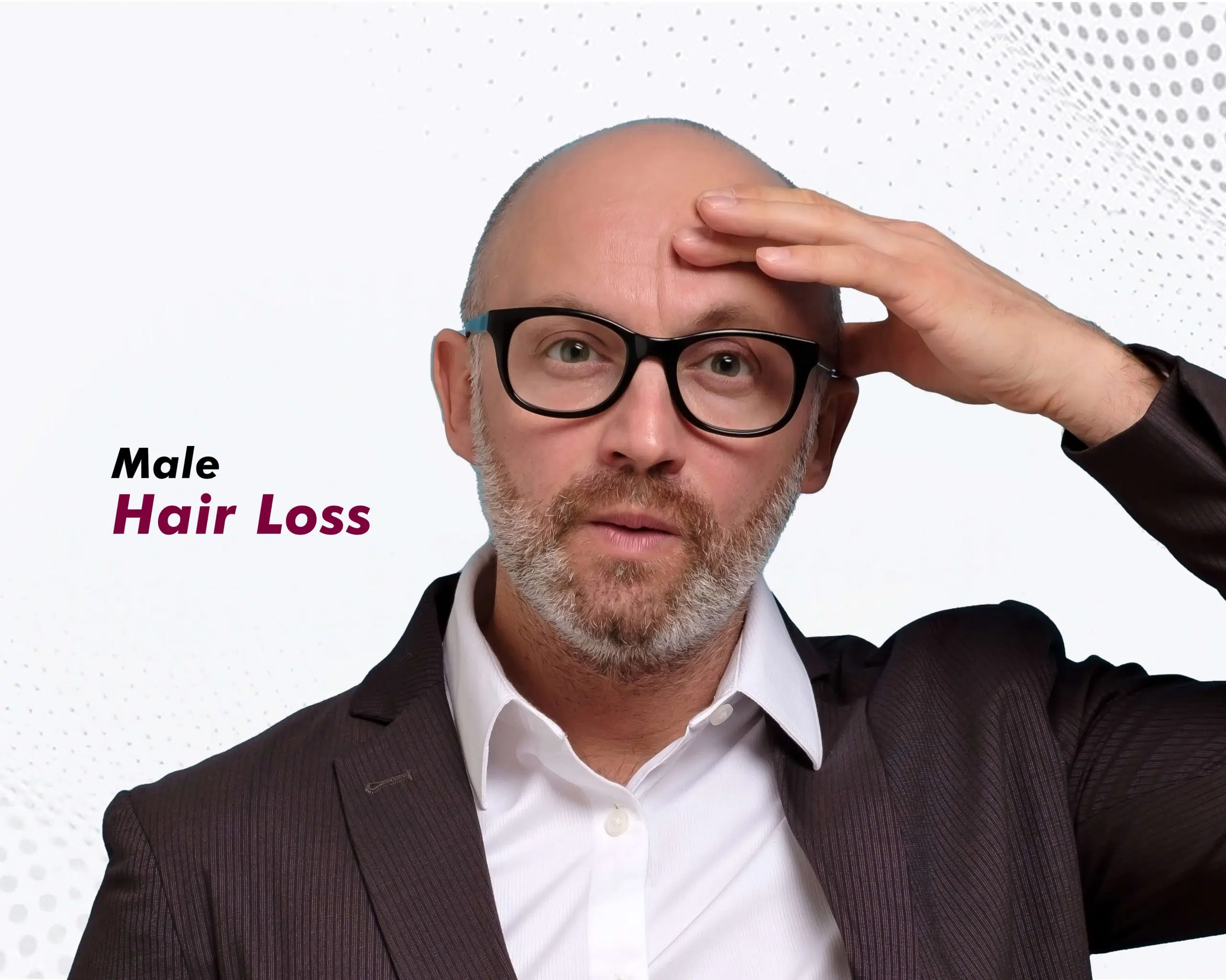 Male Hair Loss