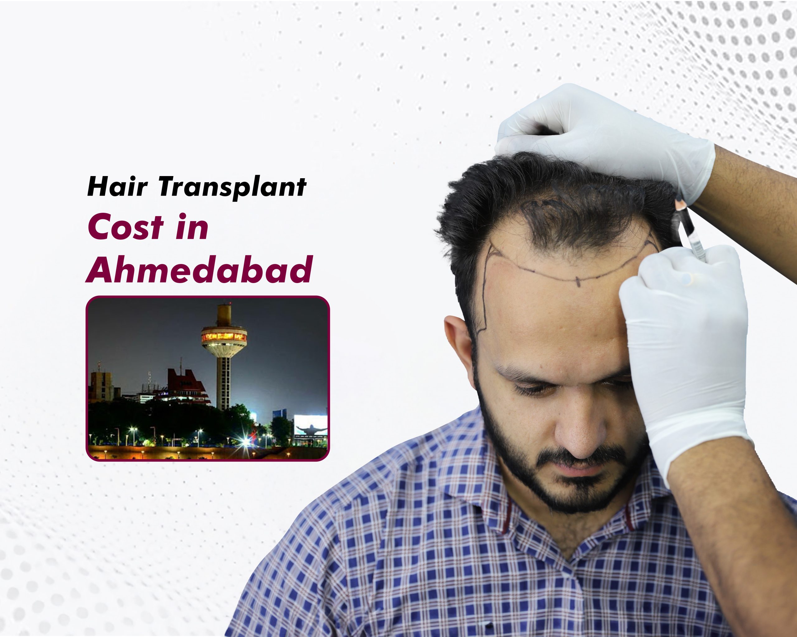 Hair Transplant Cost in Ahmedabad