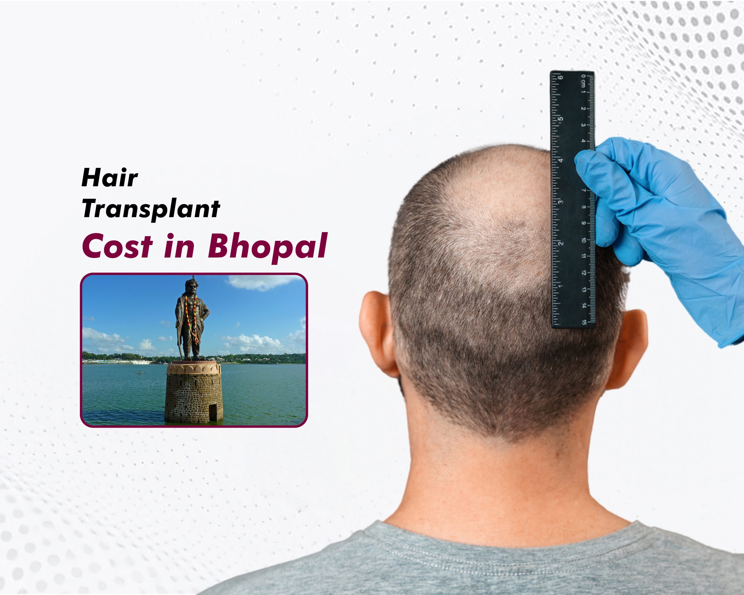 Hair Transplant Cost in Bhopal