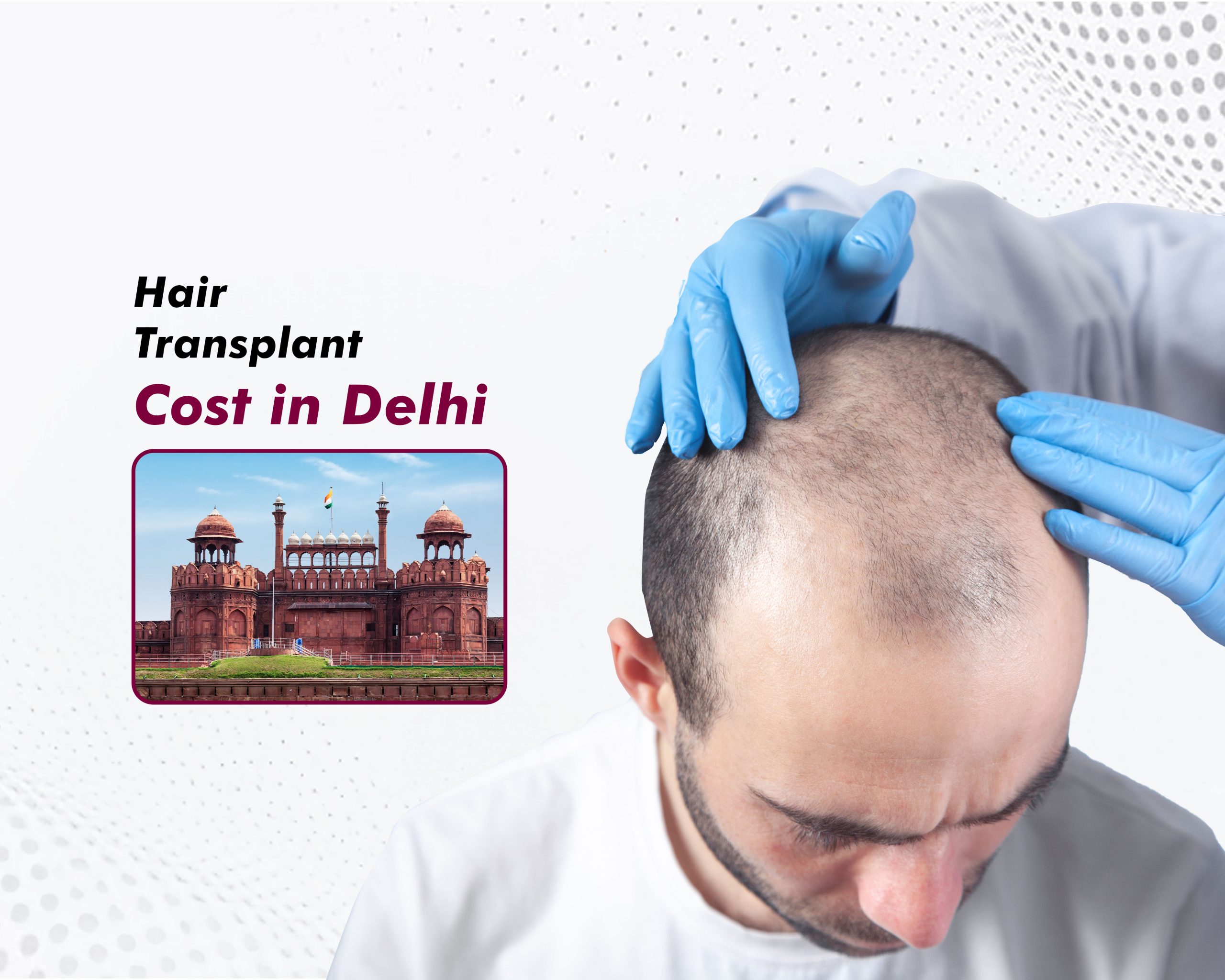 Hair Transplant Cost in Delhi