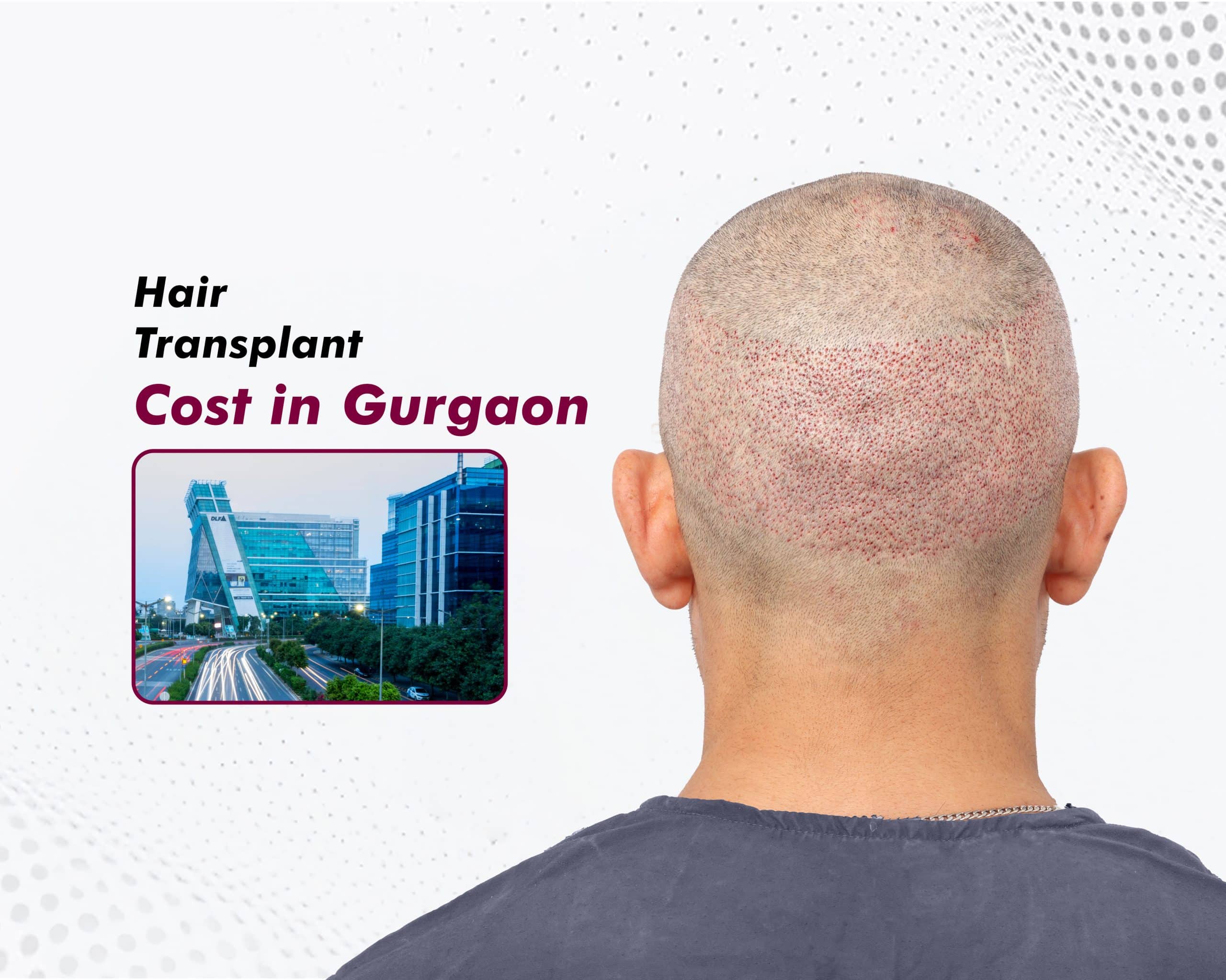 Hair Transplant Cost in Gurgaon