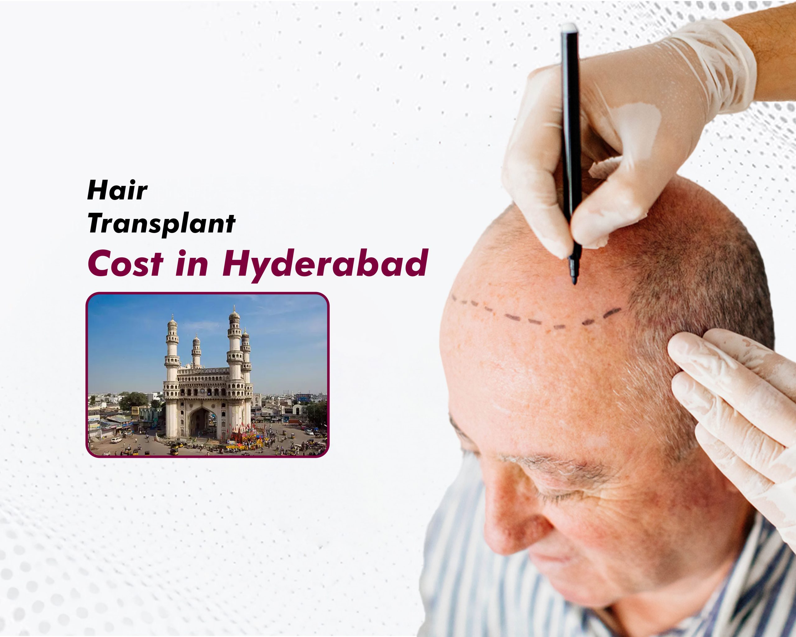 Hair Transplant Cost in Hyderabad