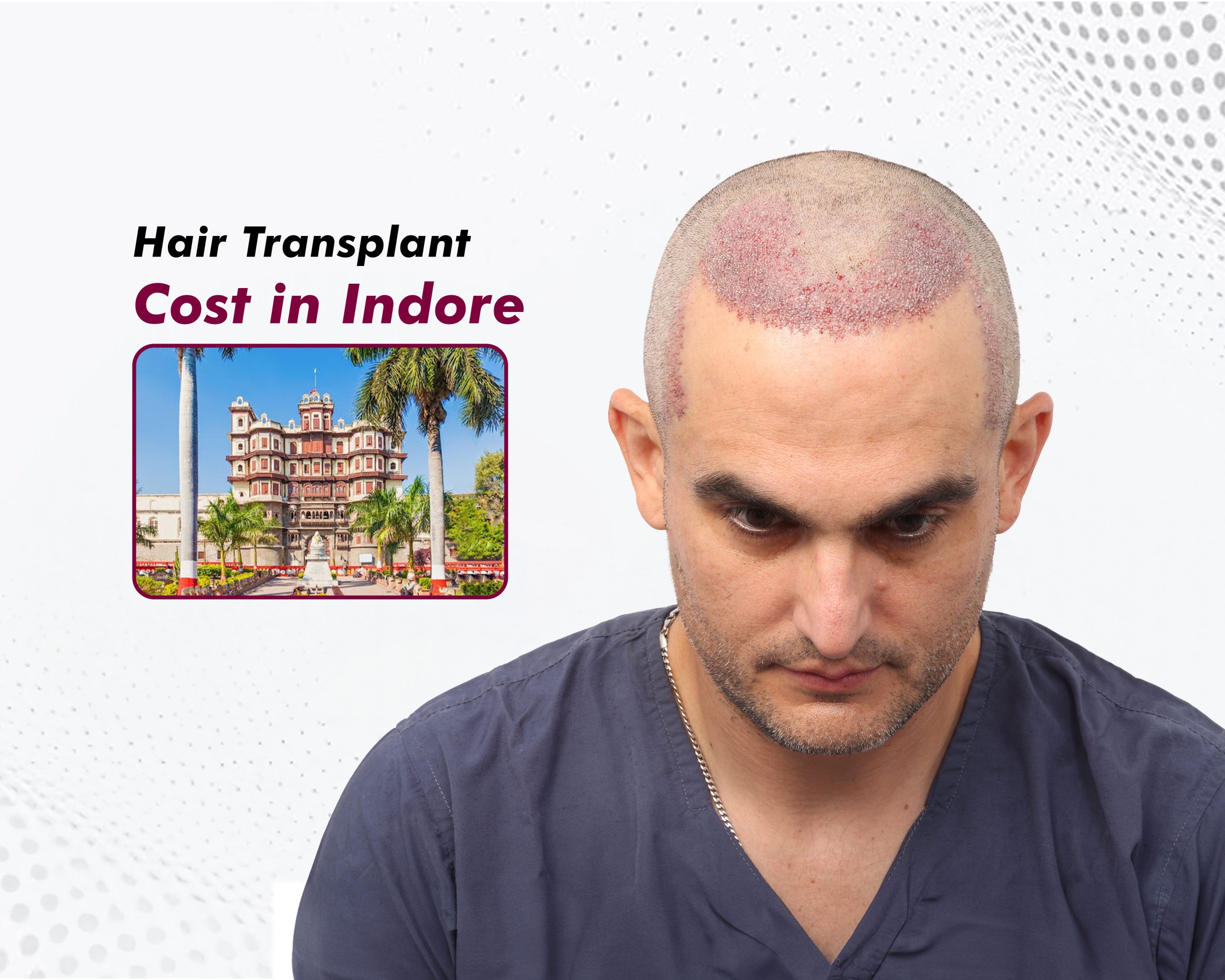 Hair Transplant Cost in Indore