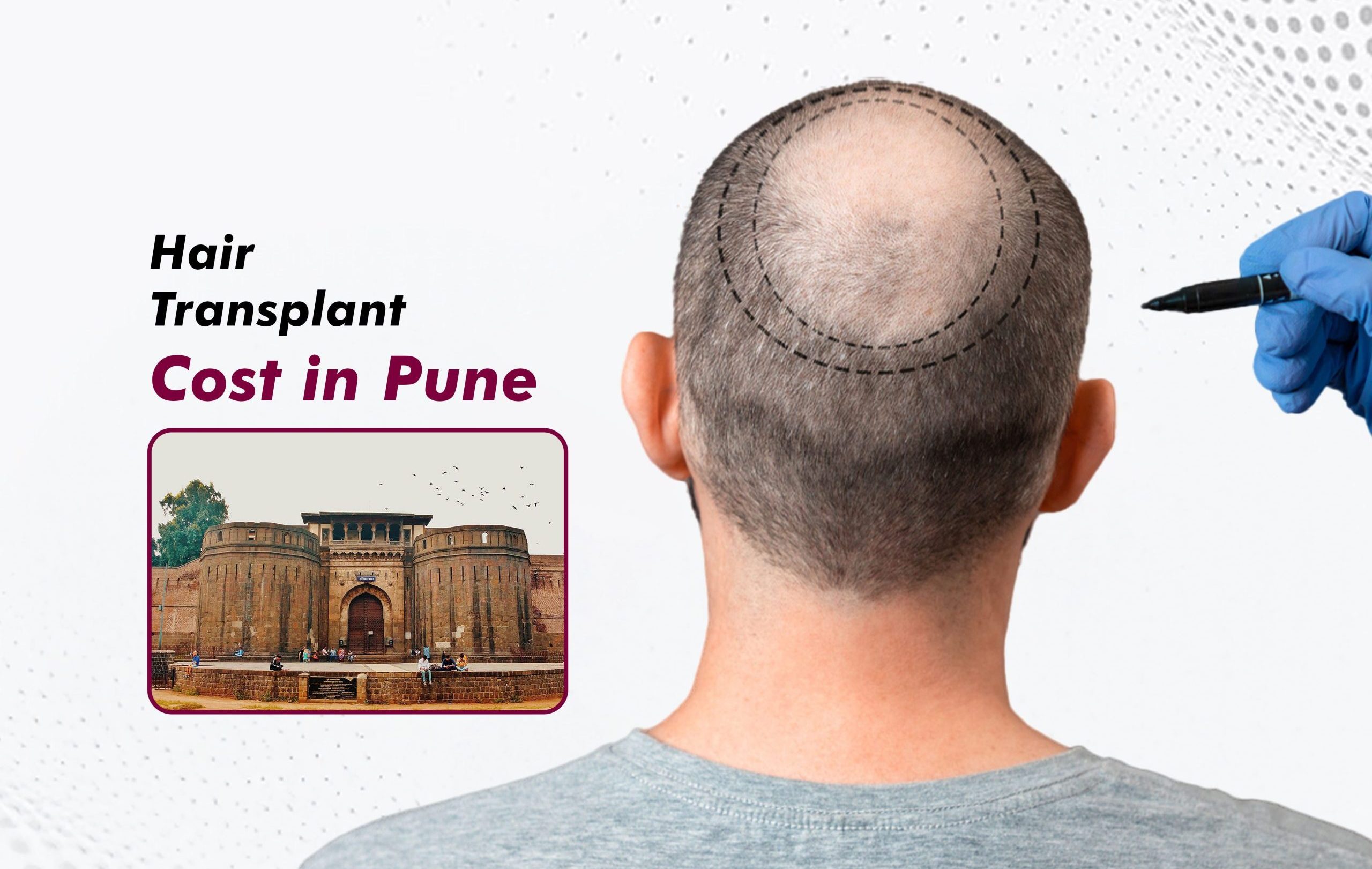 Hair Transplant Cost in Pune