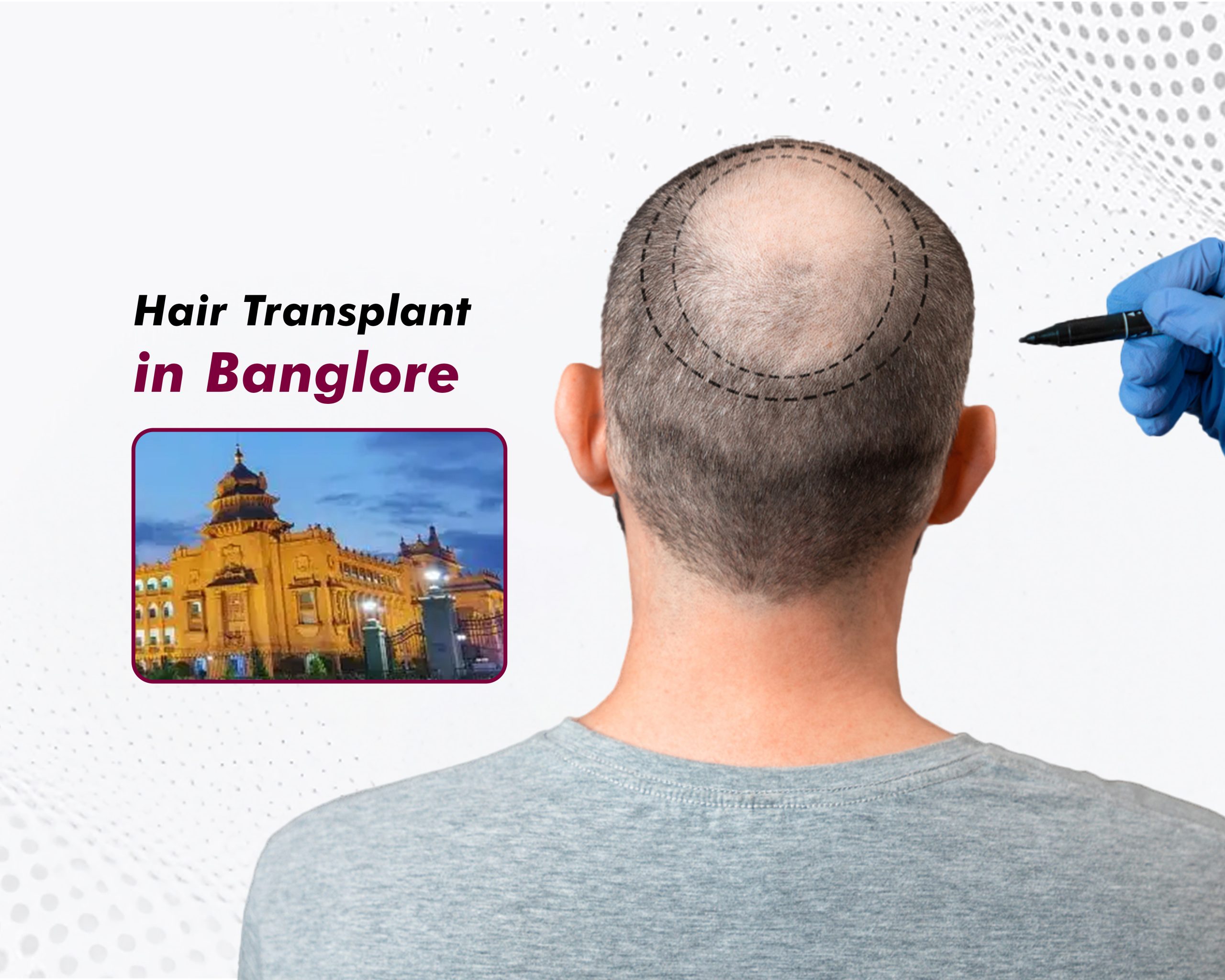Hair Transplant in Bangalore