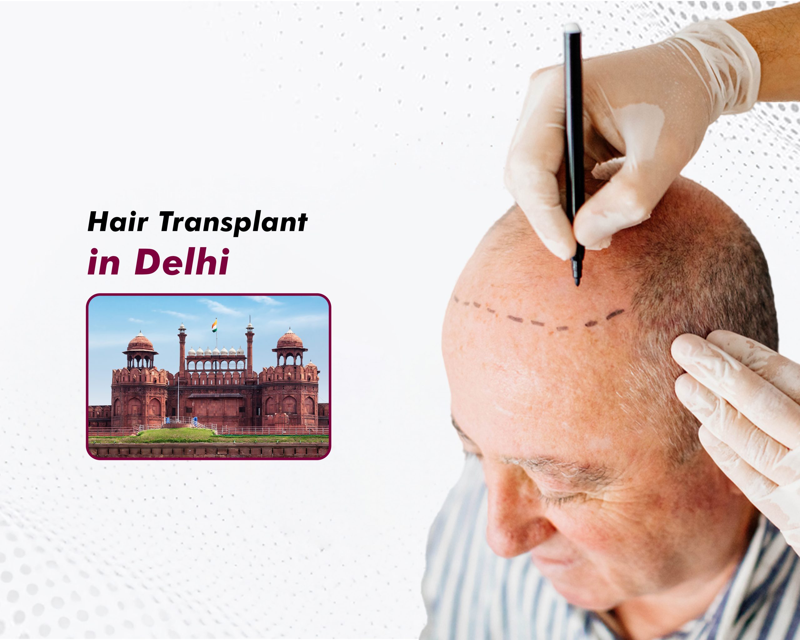 Hair Transplant in Delhi