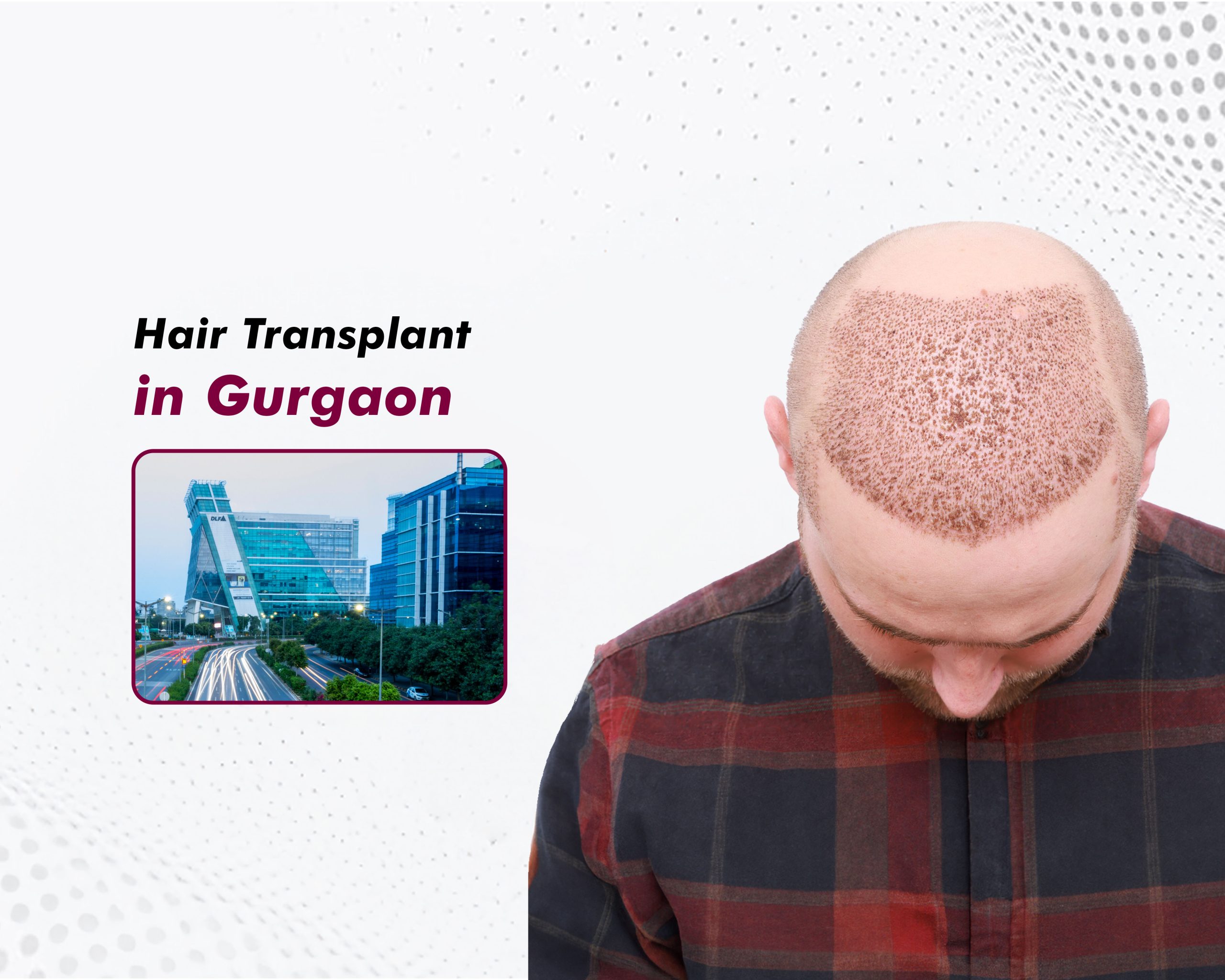 Hair Transplant in Gurgaon