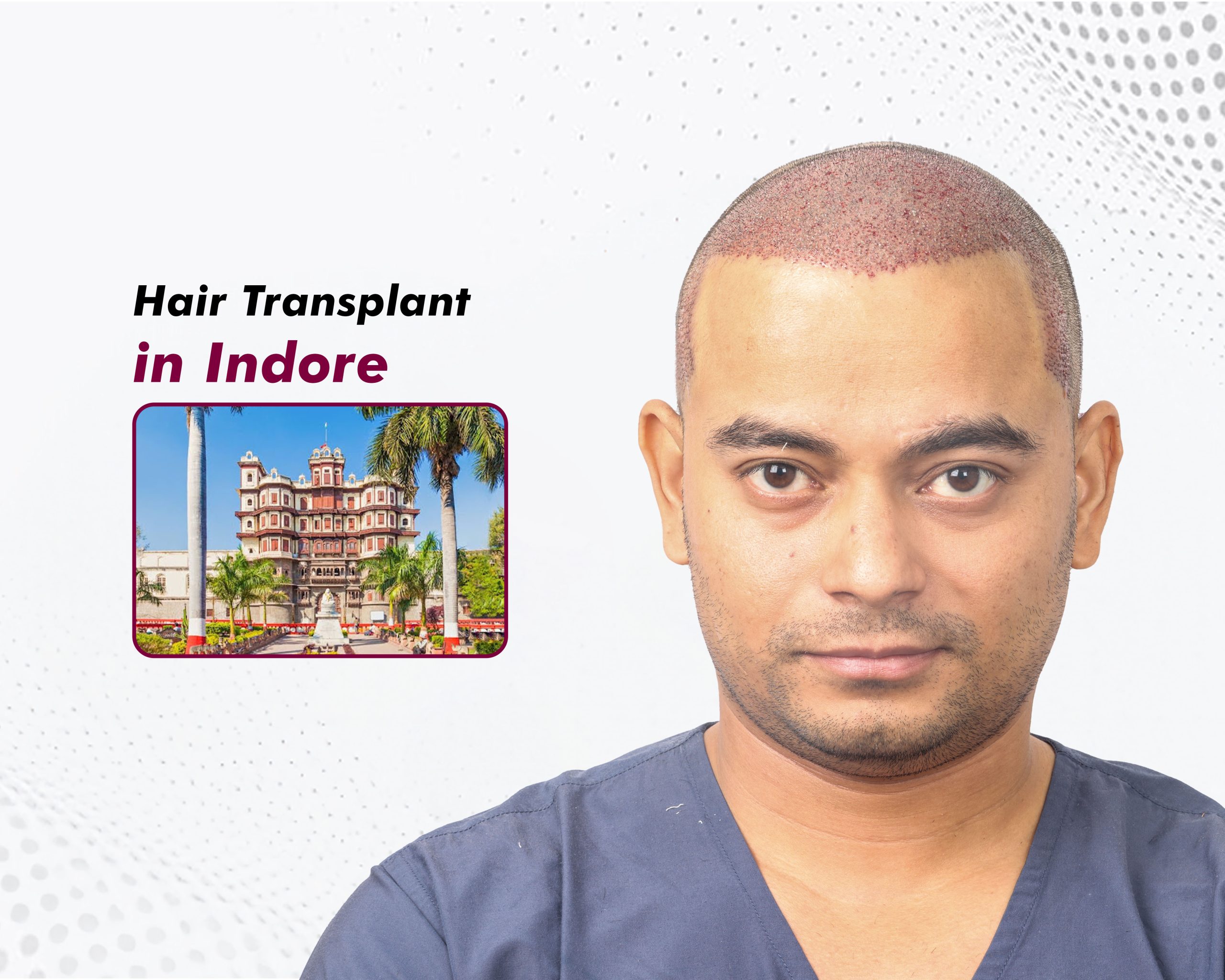 Hair Transplant in Indore