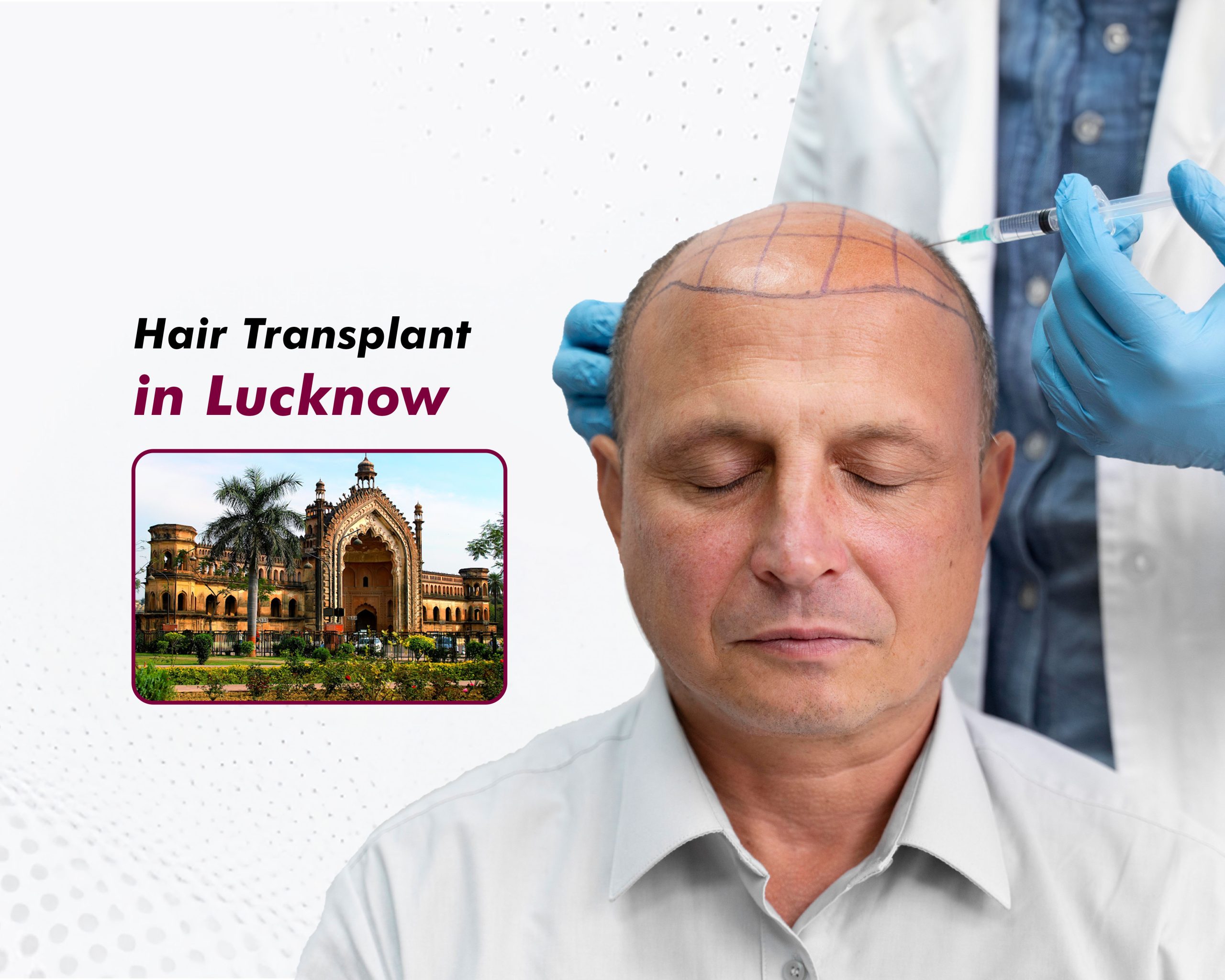 Hair Transplant in Lucknow