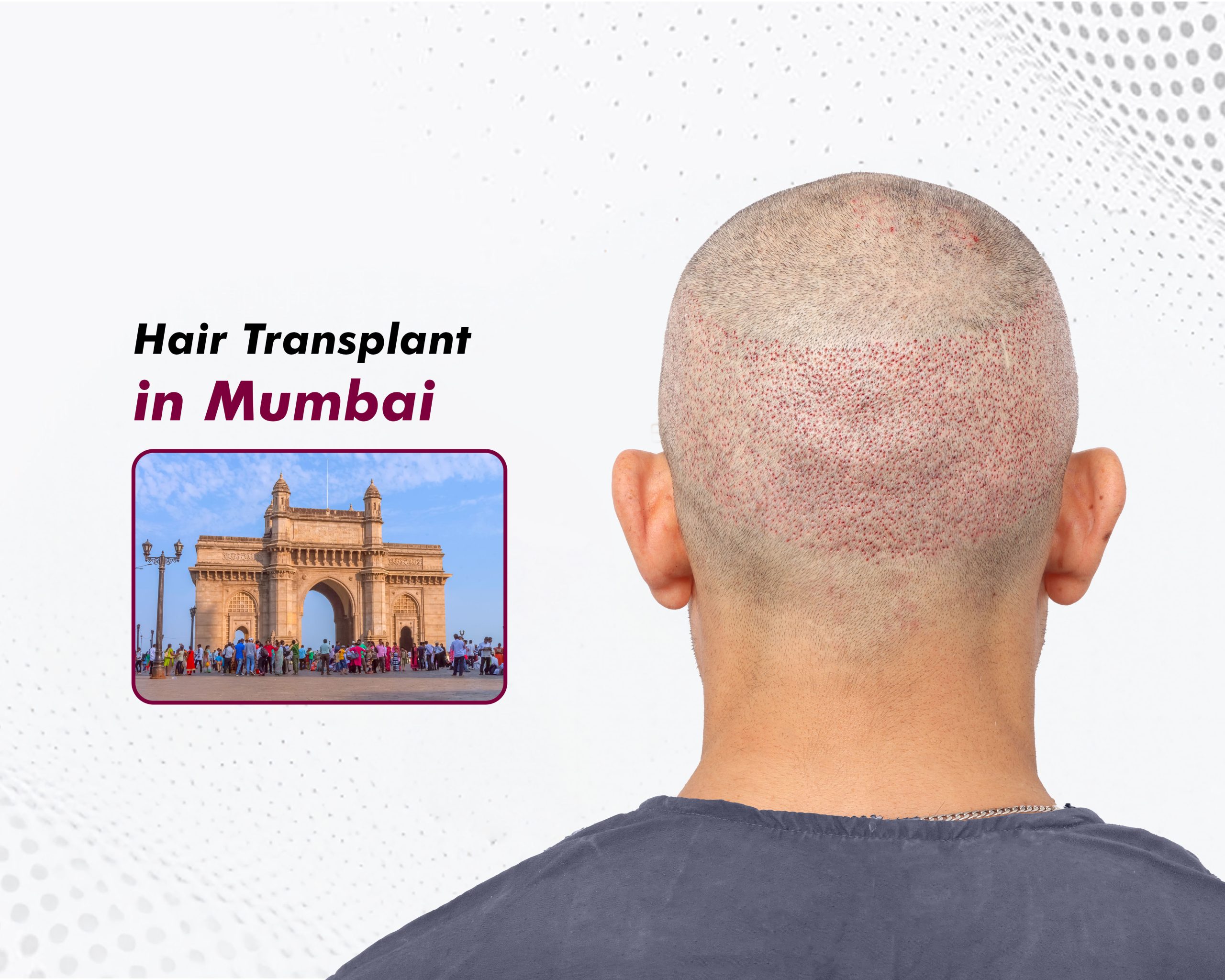 Hair-Transplant-in-Mumbai
