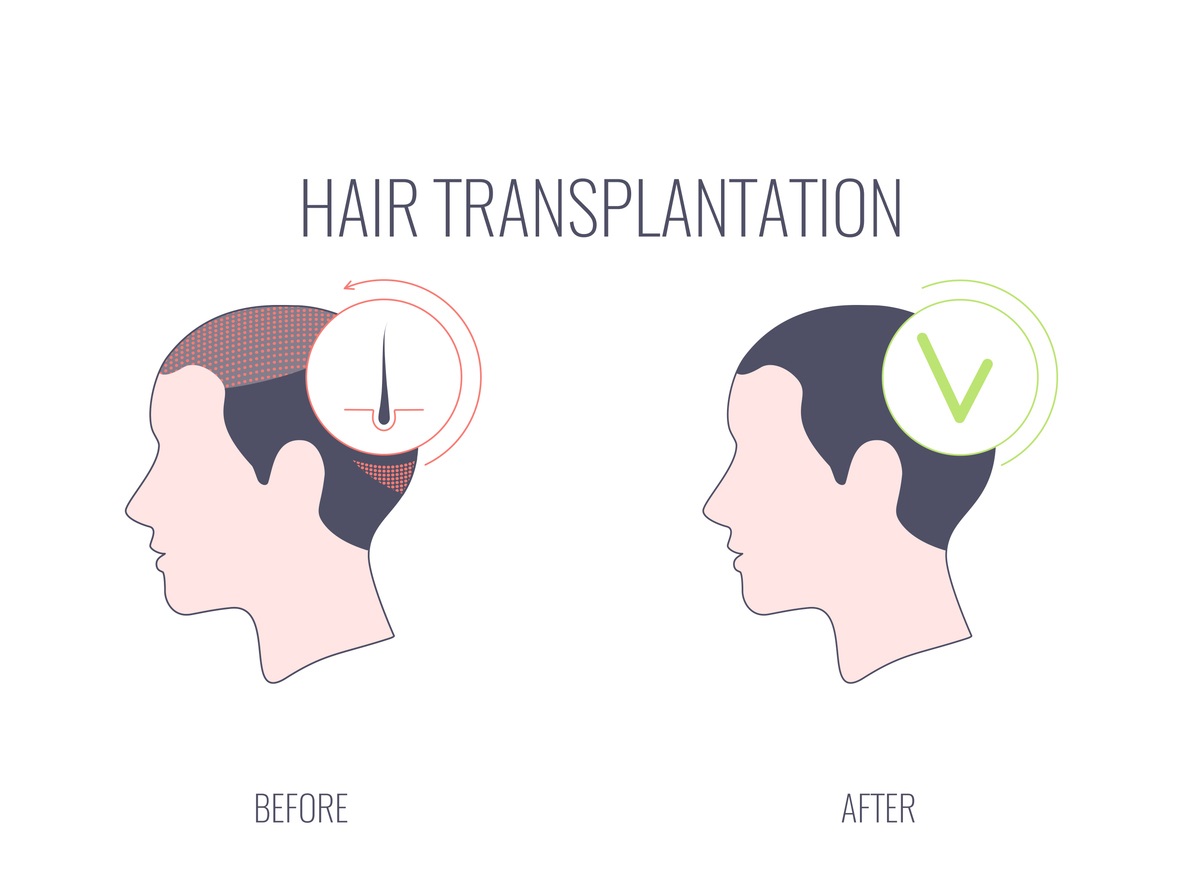 direct-hair-transplant