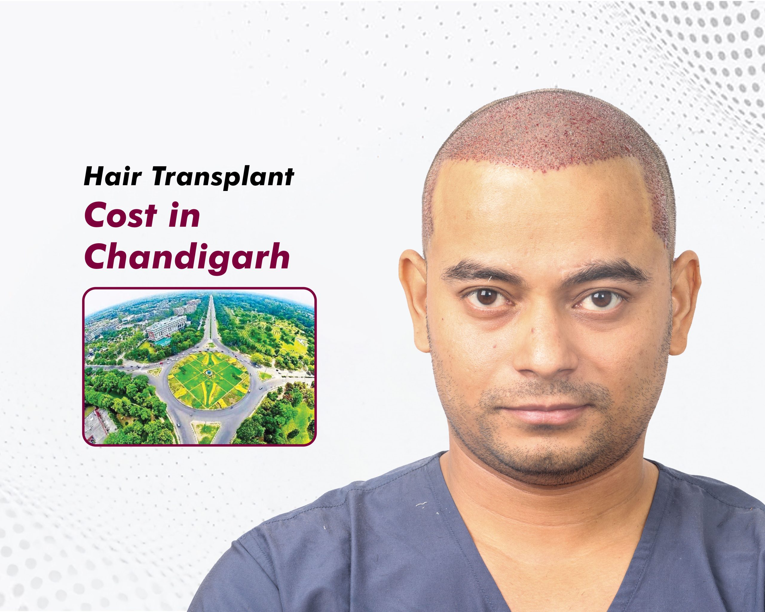 hair-transplant-cost-in-chandigarh