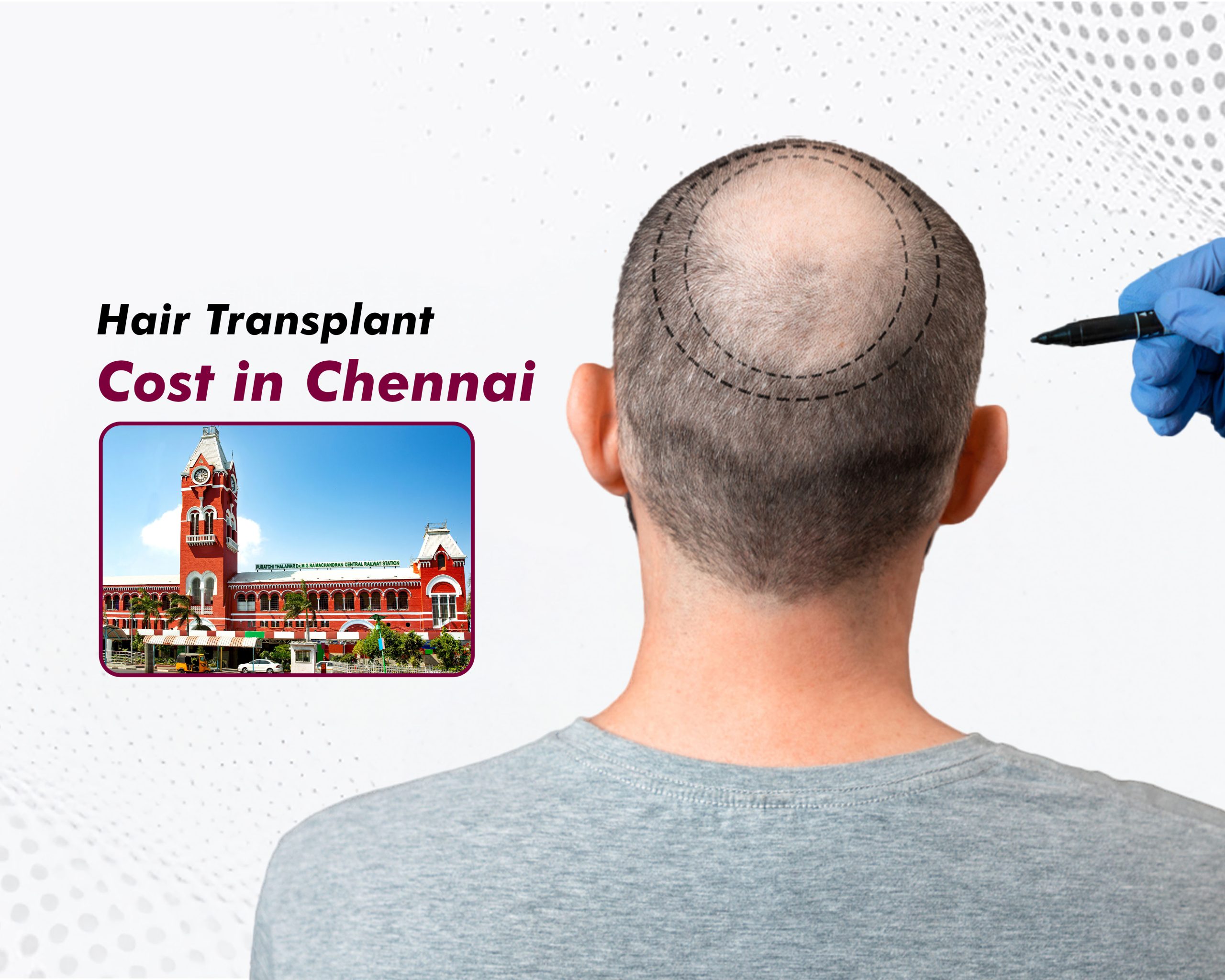 hair-transplant-cost-in-chennai