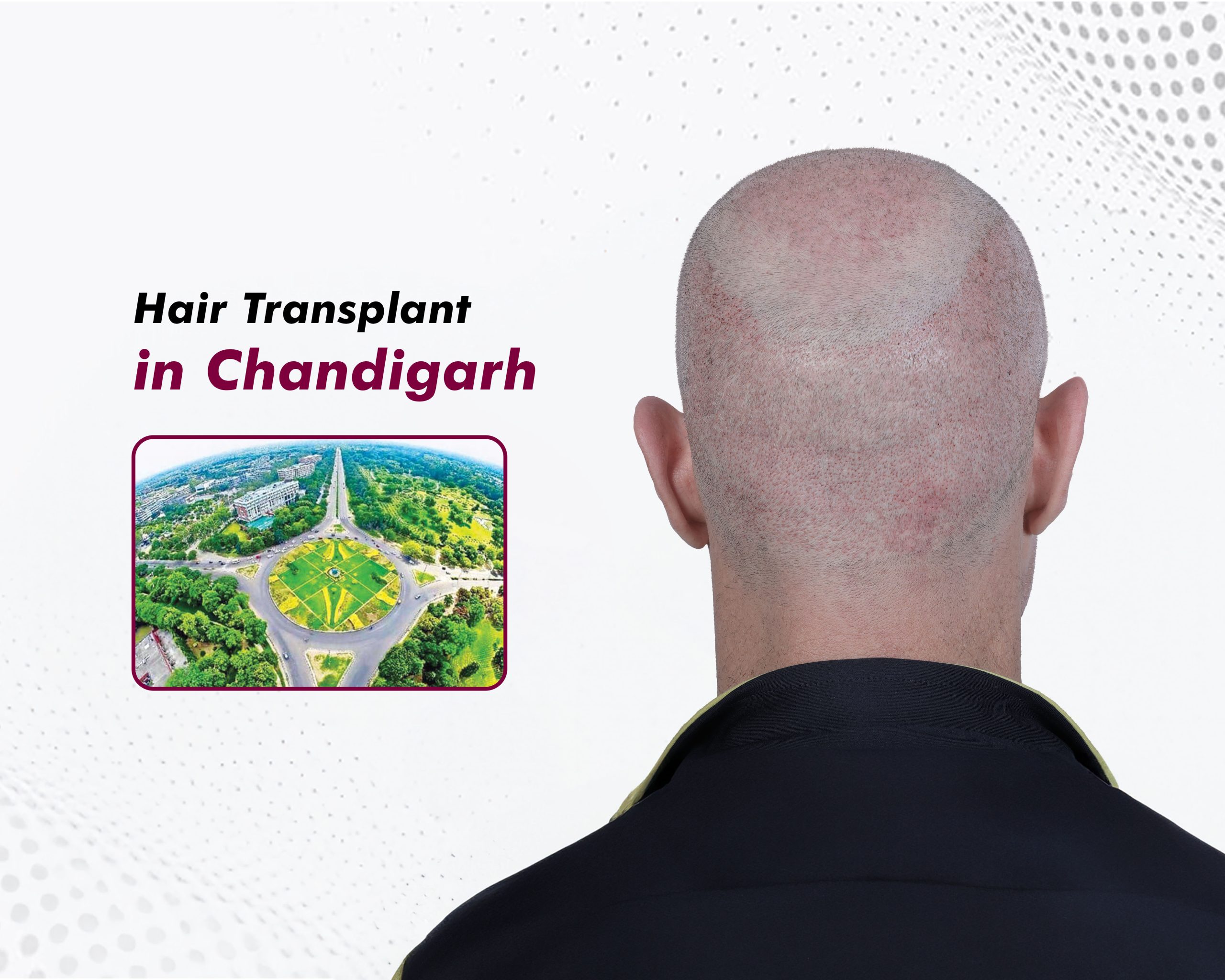 hair-transplant-in-chandigarh