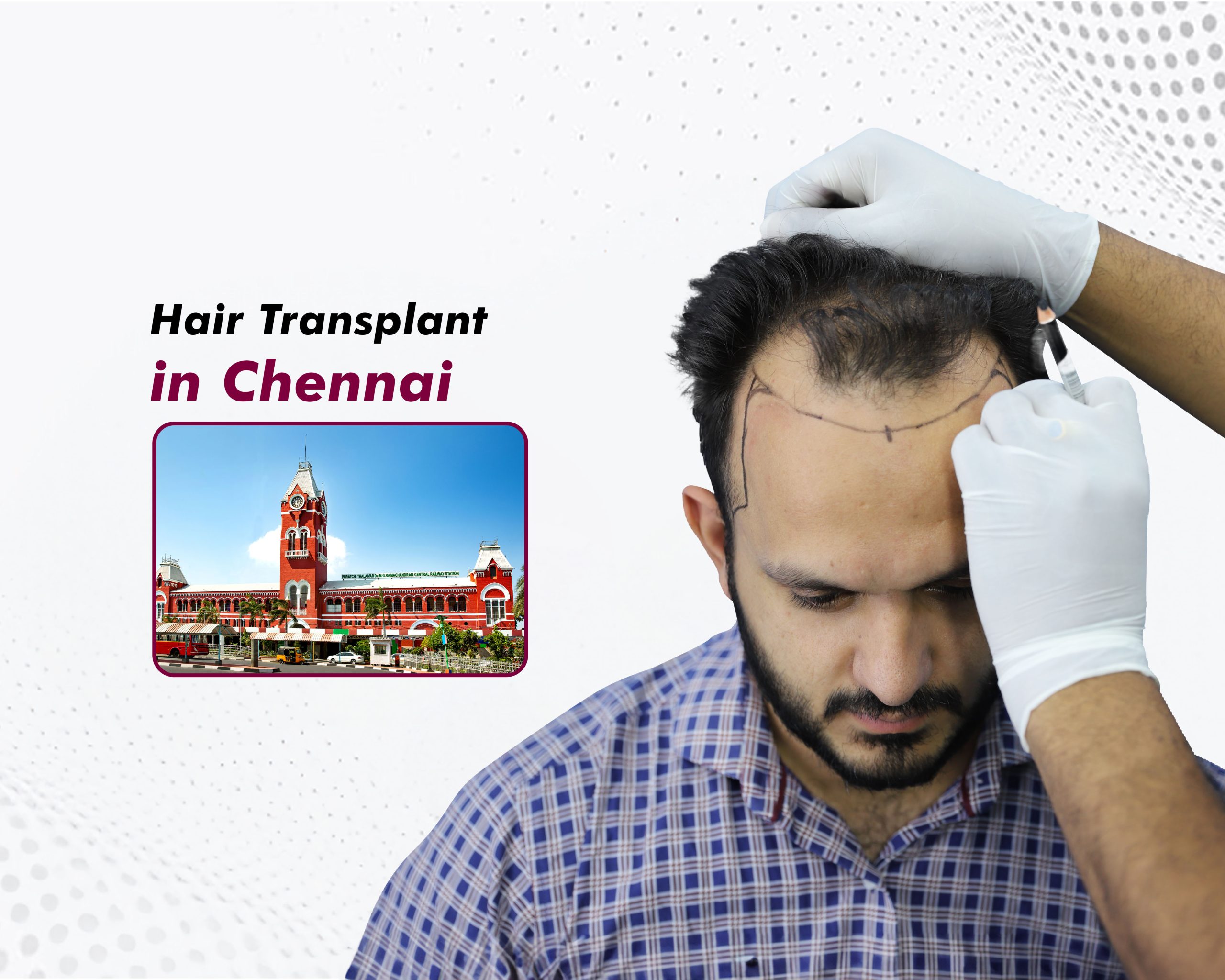 hair-transplant-in-chennai