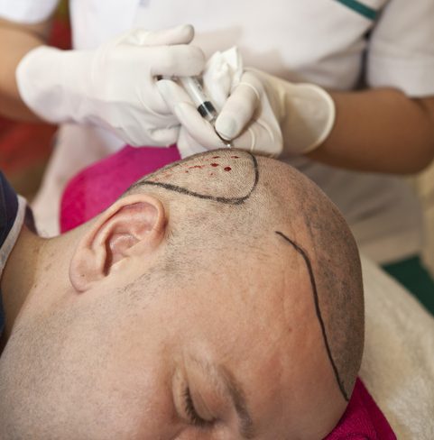 male-hair-transplant-procedure