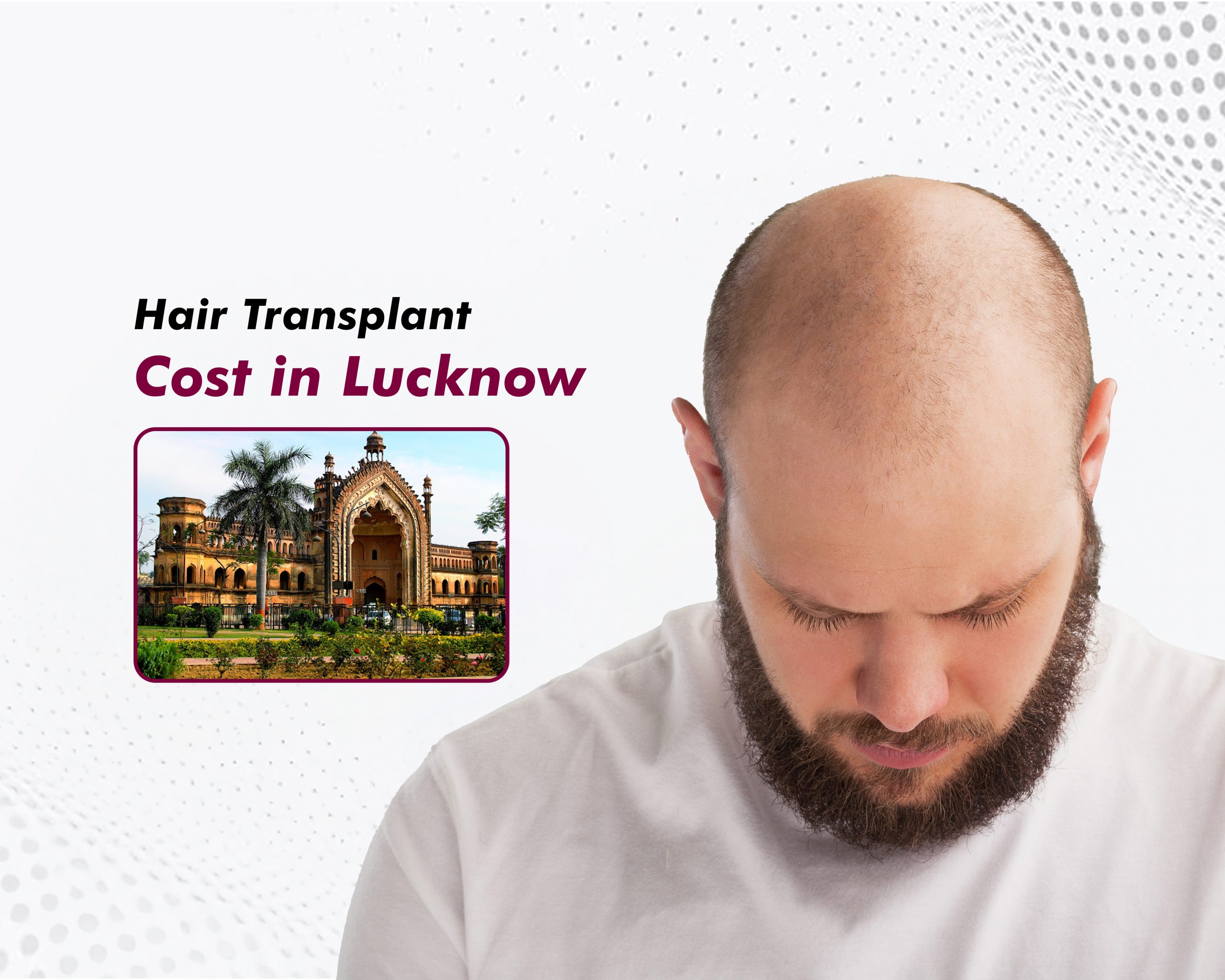 Hair Transplant Cost in Lucknow