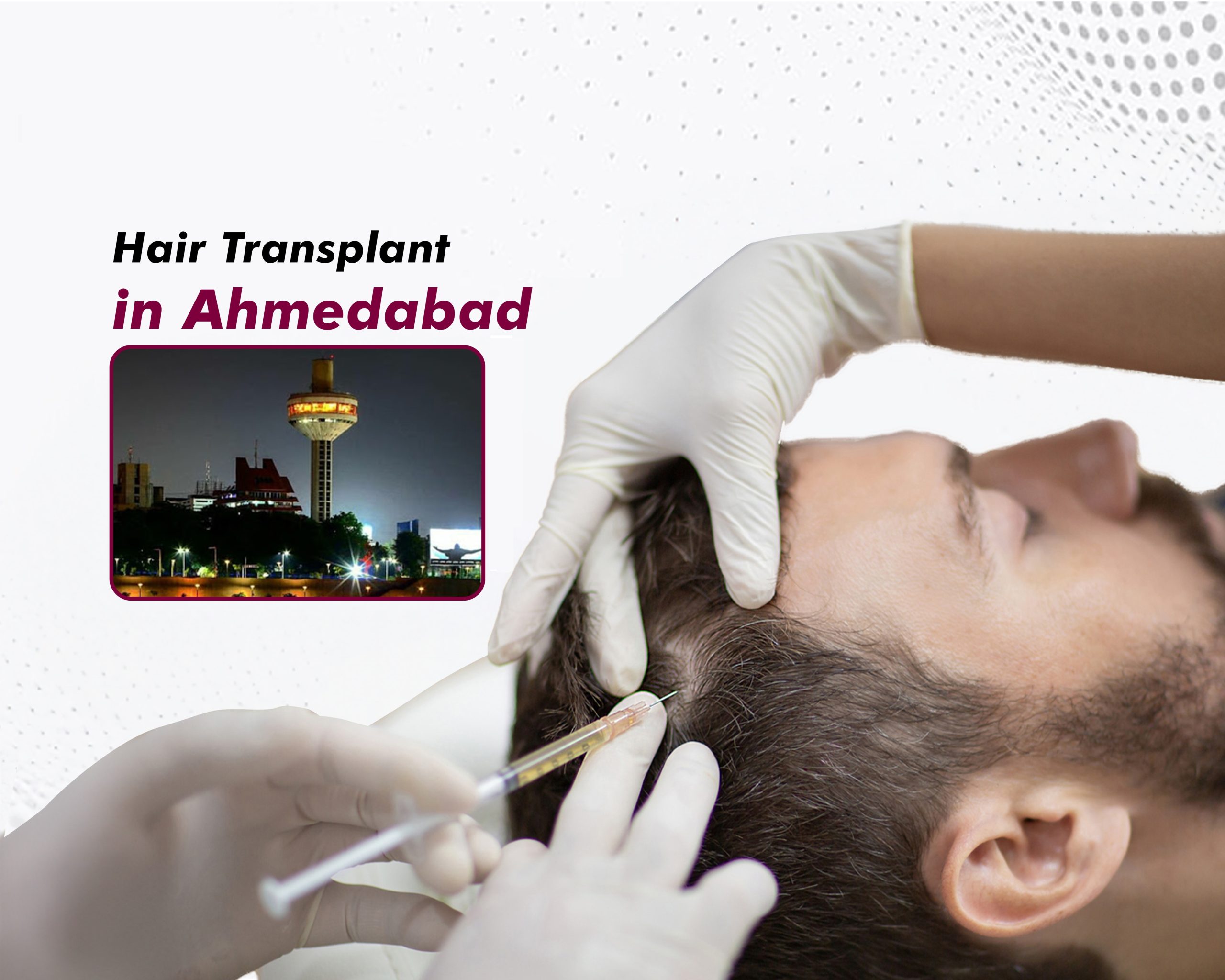 Hair-Transplant-in-Ahmedabad