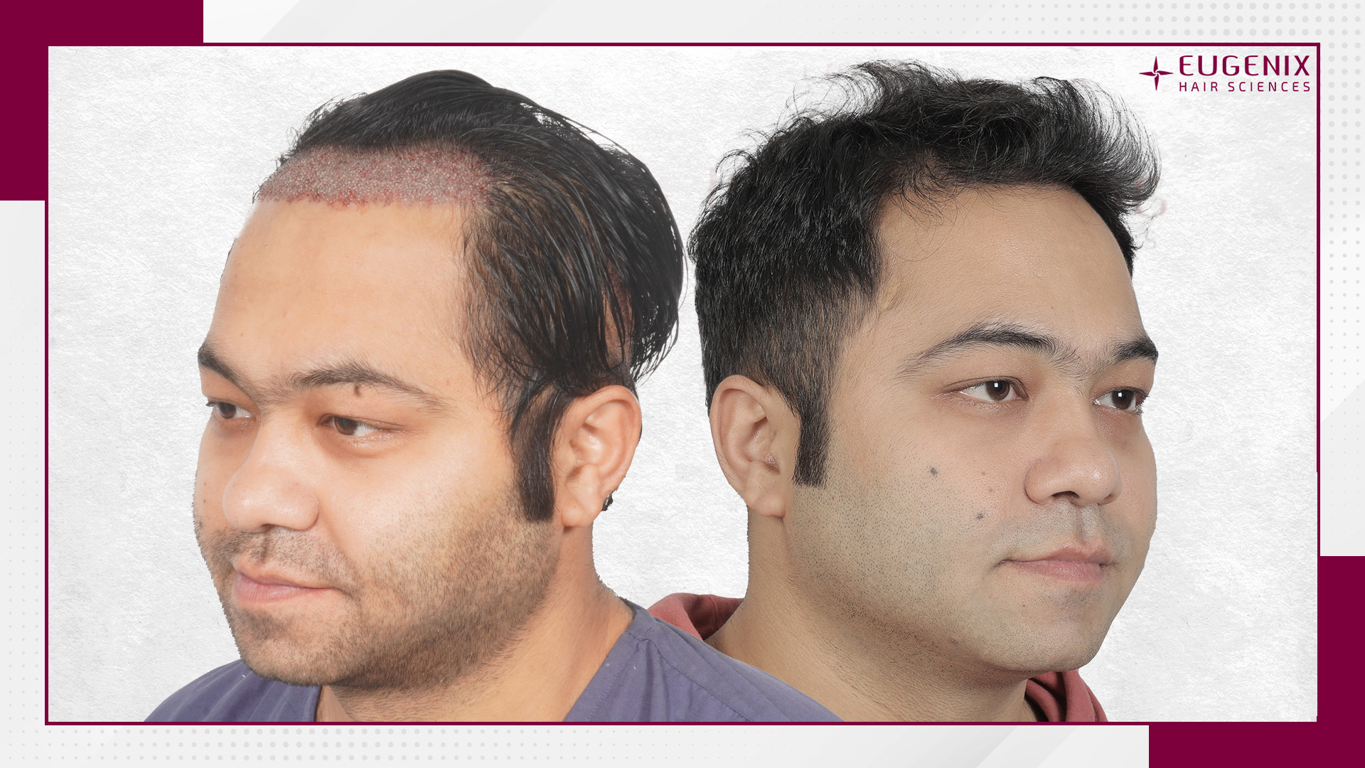 Sumit-Gulati-Hair-Transplant-Before-and-After