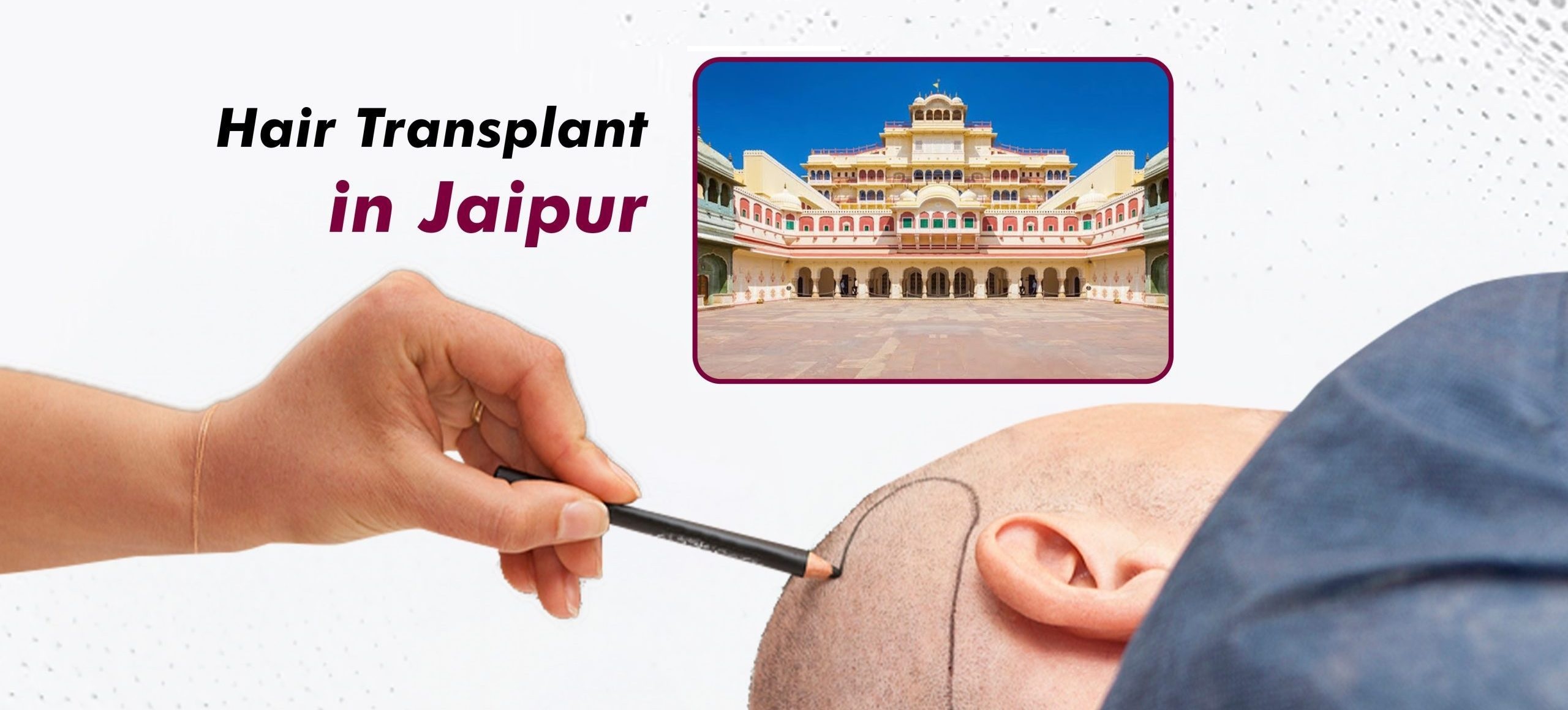 hair-transplant-in-jaipur-1-scaled-e1722252918469