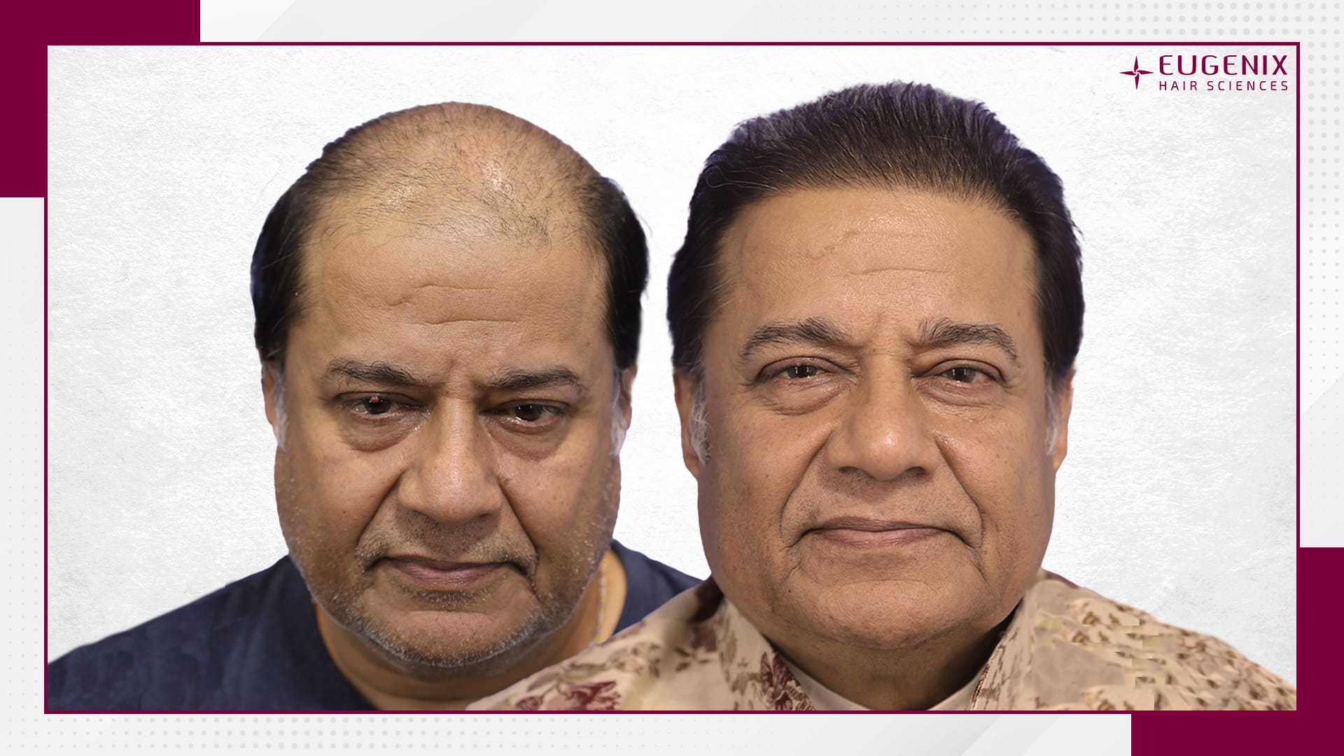 anup-jalota-hair-transplant