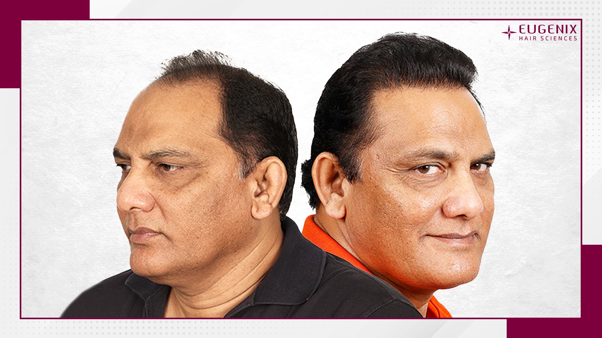 azhar-hair-transplant