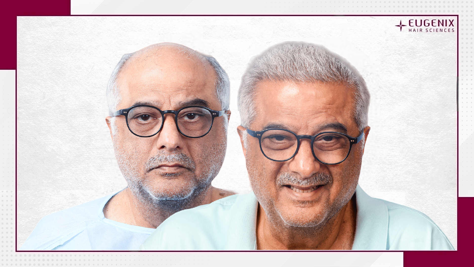 boney-kapoor-hair-transplant-results-2