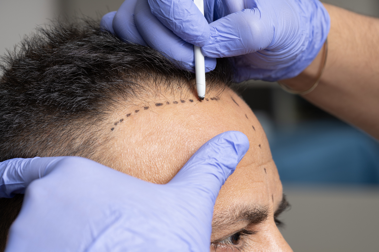 Choosing a Hair Transplant Surgeon Who Blends Science and Skill