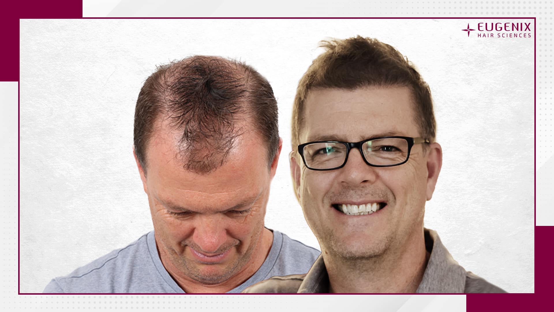 male-hair-transplant-before-and-after-uk-10