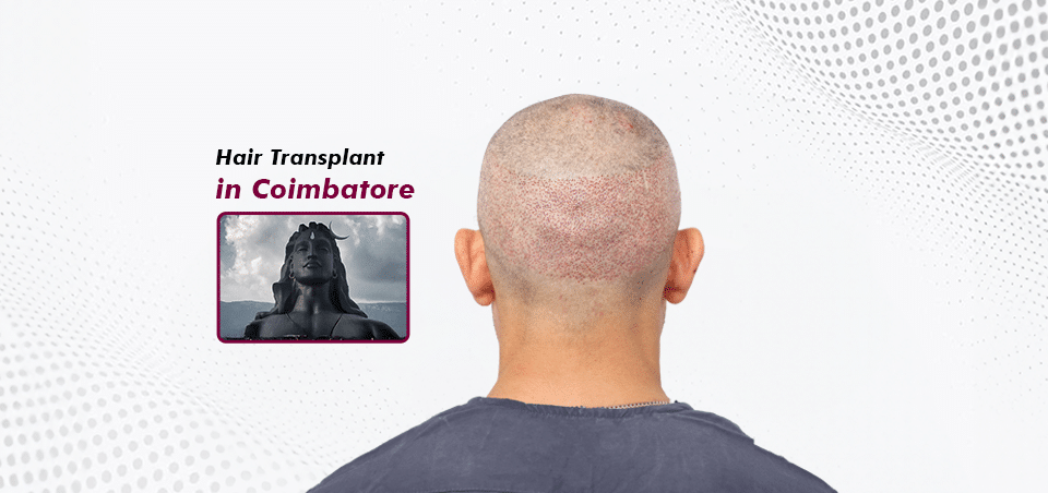 Hair Transplant-in Coimbatore