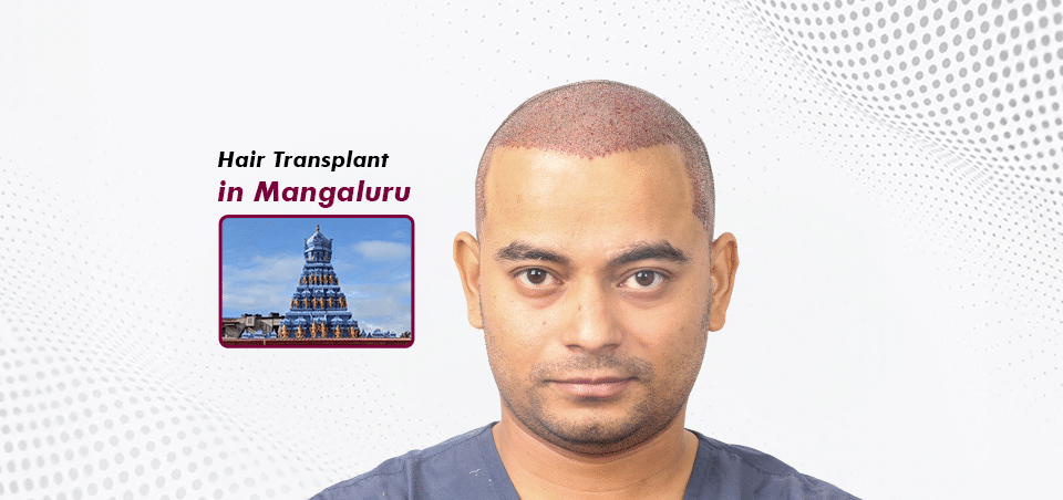Hair Transplant-in Mangalore