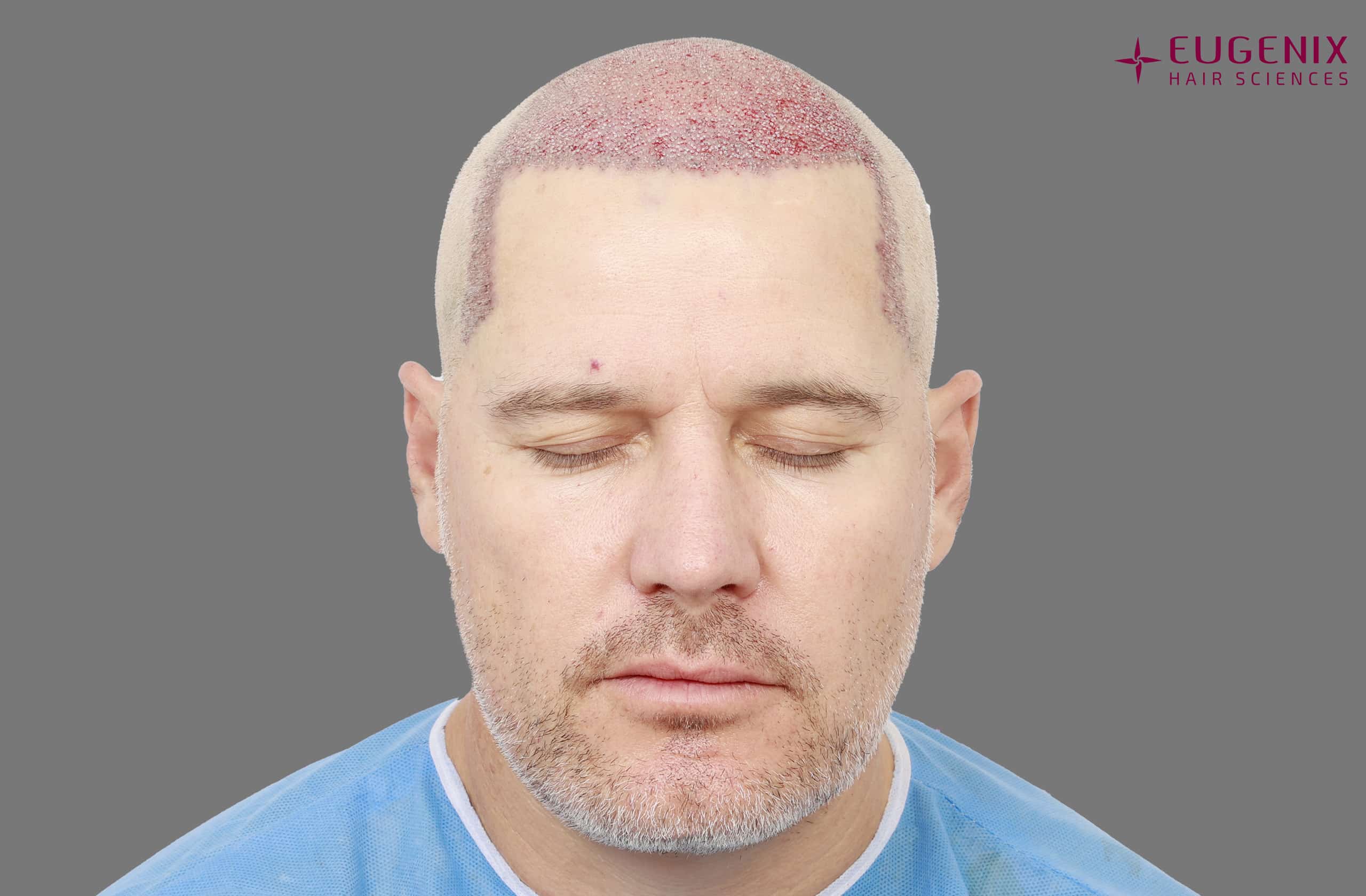 Morne Van Wyk Post-op Front