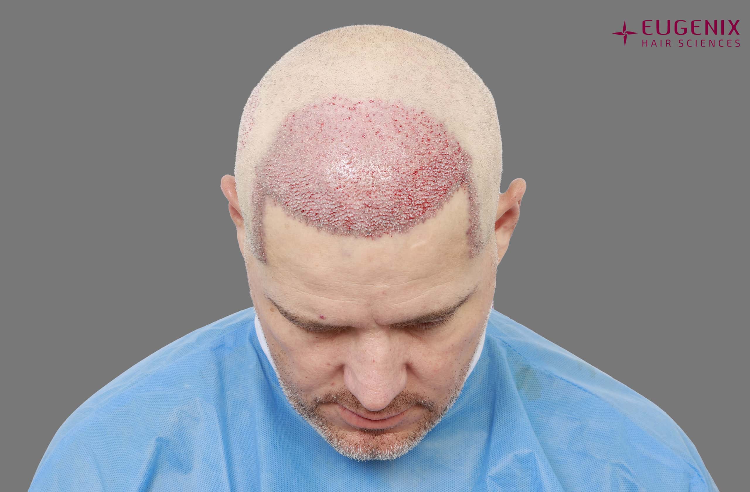 Morne Van Wyk Post-op Head Down